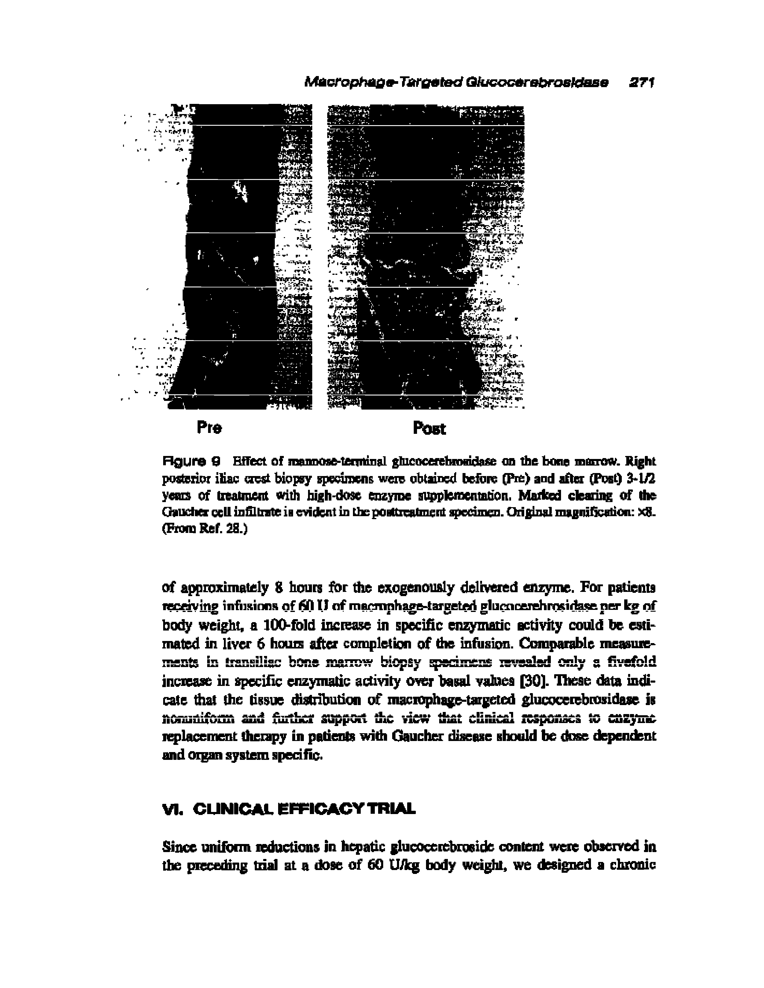 Figure 9 Effect of jnaimose-tenmnal ghicocerefanMidasc on the bone morrow. Right posterior iliac crest biopsy specimens were obtained before (Pre) and after (Post) 3 1/2 yearn of treatment with bigh-dost enzyme supplementation. Marked clearing of the Gaucher cell in Si bate is evident in the pOHttxcalment specimen. Original magnification XJJ. (Frora Ref. 28.)...