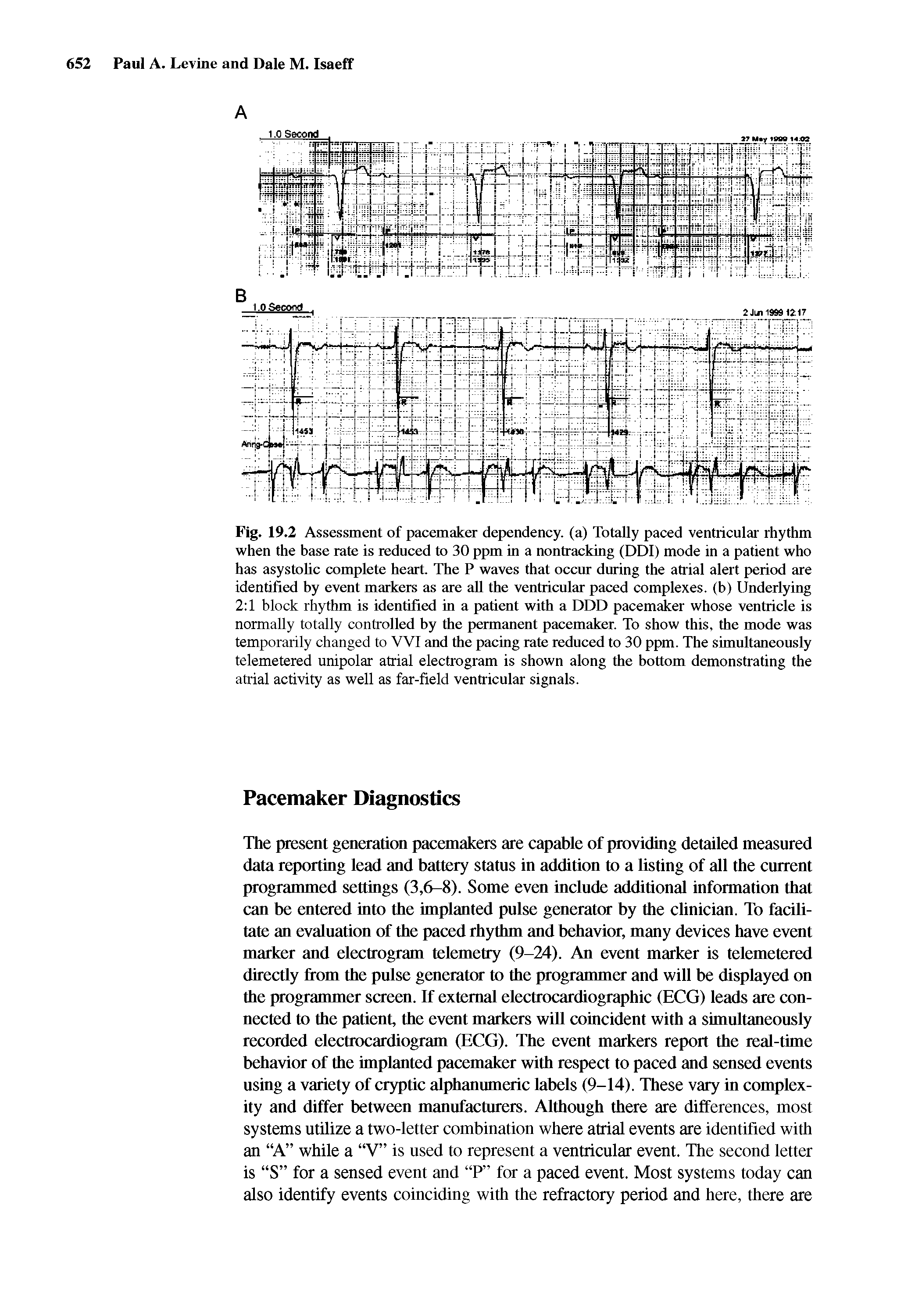 Fig. 19.2 Assessment of pacemaker dependency, (a) Totally paced ventricular rhythm when the base rate is reduced to 30 ppm in a nontracking (DDI) mode in a patient who has asystoUc complete heart The P waves that occur during the atrial alert period are identified by event markers as are all the ventricular paced complexes, (b) Underlying 2 1 block rhythm is identified in a patient with a DDD pacemaker whose ventricle is normally totally controlled by the permanent pacemaker. To show this, the mode was temporarily changed to VVI and the pacing rate reduced to 30 ppm. The simultaneously telemetered unipolar atrial electrogram is shown along the bottom demonstrating the atrial activity as well as far-field ventricular signals.