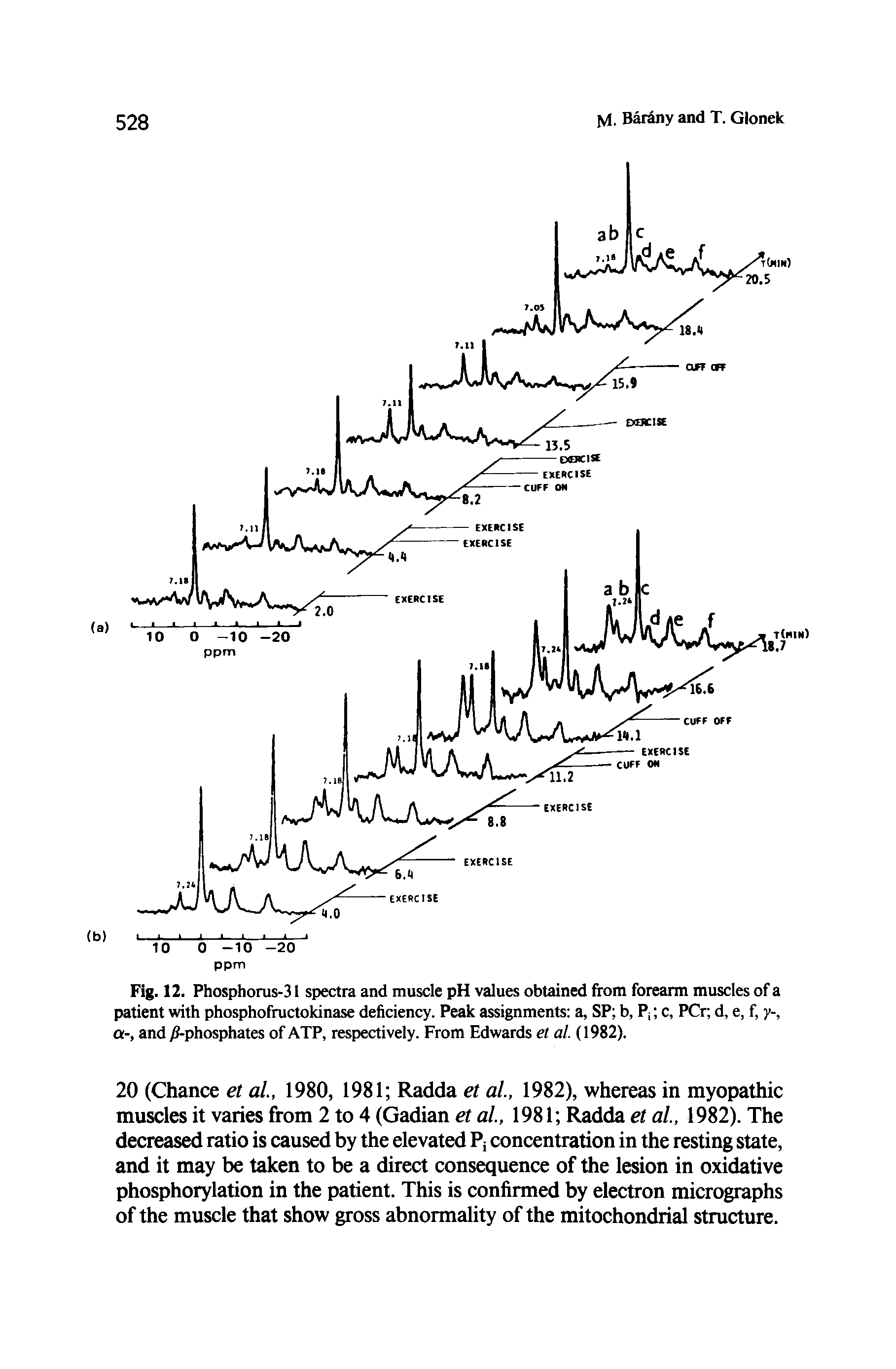 Fig. 12. Phosphorus-31 spectra and muscle pH values obtained from forearm muscles of a patient with phosphofructokinase deficiency. Peak assignments a, SP b, Pj c, PCr, d, e, f, y-, a-, and phosphates of ATP, respectively. From Edwards et al. (1982).