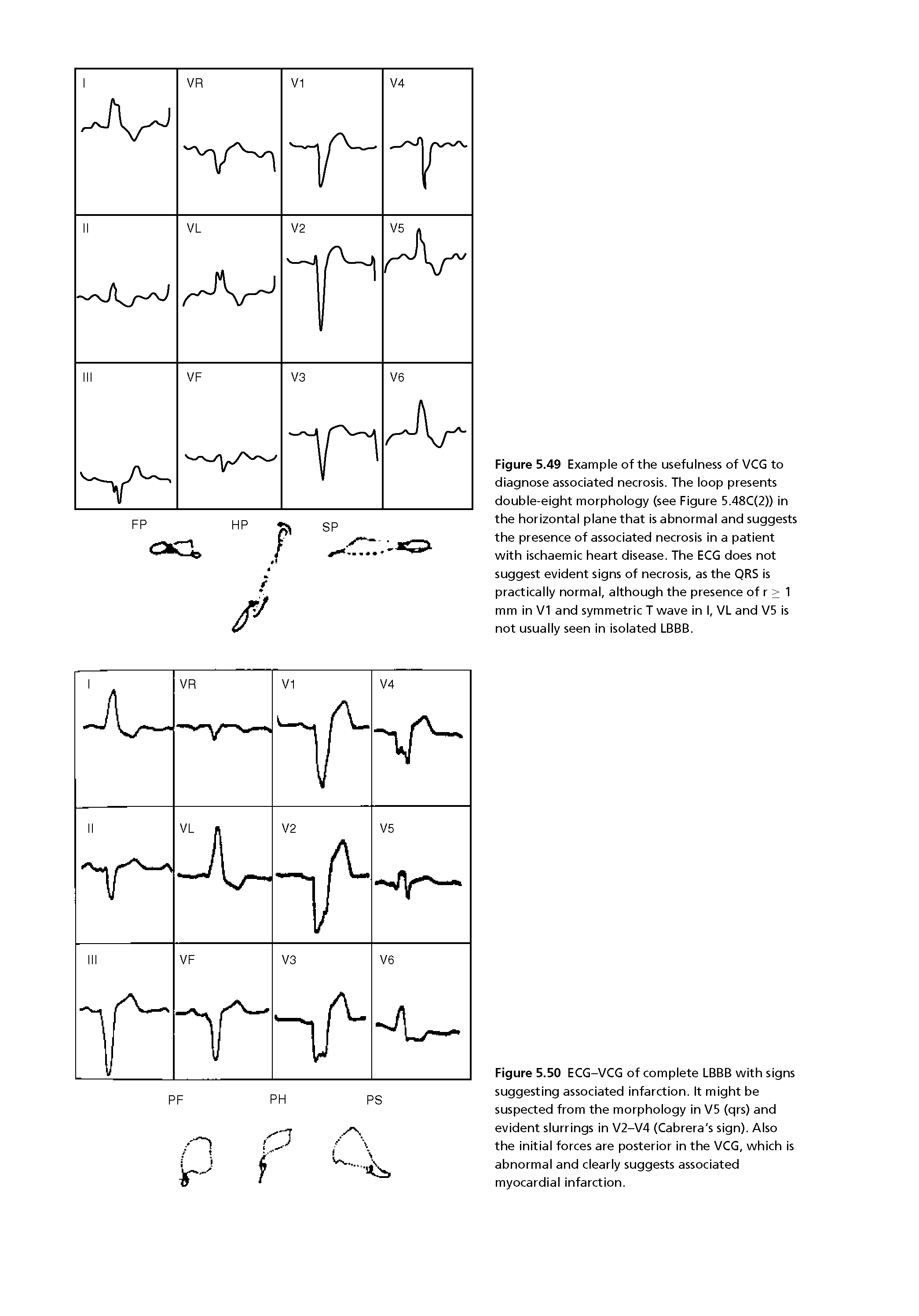 Figure 5.49 Example of the usefulness of VCG to diagnose associated necrosis. The loop presents double-eight morphology (see Figure 5.48C(2)) in the horizontal plane that is abnormal and suggests the presence of associated necrosis in a patient with ischaemic heart disease. The ECG does not suggest evident signs of necrosis, as the QRS is practically normal, although the presence of r > 1 mm in V1 and symmetric T wave in I, VL and V5 is not usually seen in isolated LBBB.