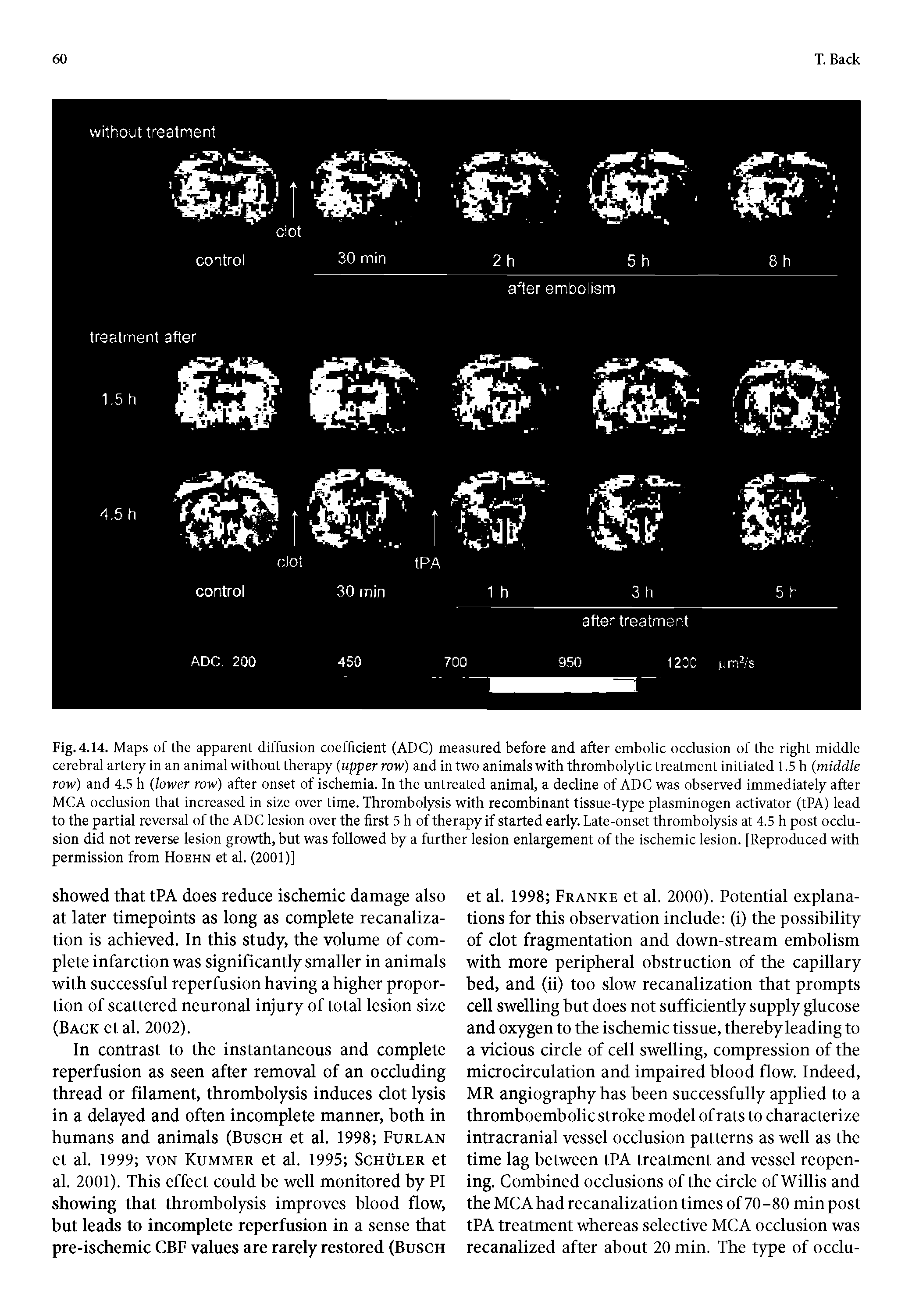 Fig. 4.14. Maps of the apparent diffusion coefficient (ADC) measured before and after embolic occlusion of the right middle cerebral artery in an animal without therapy (upper row) and in two animals with thrombolytic treatment initiated 1.5 h (middle row) and 4.5 h (lower row) after onset of ischemia. In the untreated animal, a decline of ADC was observed immediately after MCA occlusion that increased in size over time. Thrombolysis with recombinant tissue-type plasminogen activator (tPA) lead to the partial reversal of the ADC lesion over the first 5 h of therapy if started early. Late-onset thrombolysis at 4.5 h post occlusion did not reverse lesion growth, but was followed by a further lesion enlargement of the ischemic lesion. [Reproduced with permission from Hoehn et al. (2001)]...