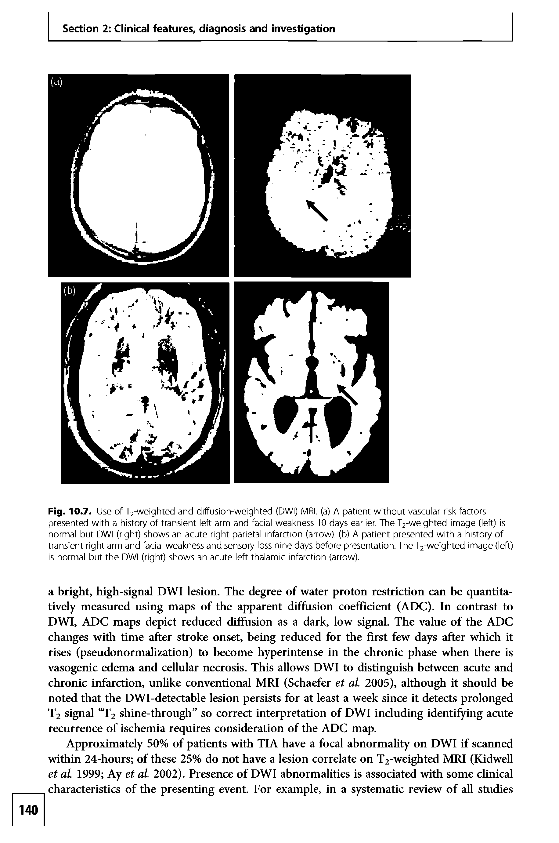 Fig. 10.7. Use of T2-weighted and diffusion-weighted (DWI) MRI. (a) A patient without vascular risk factors presented with a history of transient left arm and facial weakness 10 days earlier. The T2-weighted image (left) is normal but DWI (right) shows an acute right parietal infarction (arrow), (b) A patient presented with a history of transient right arm and facial weakness and sensory loss nine days before presentation. The T2-weighted image (left) is normal but the DWI (right) shows an acute left thalamic infarction (arrow).