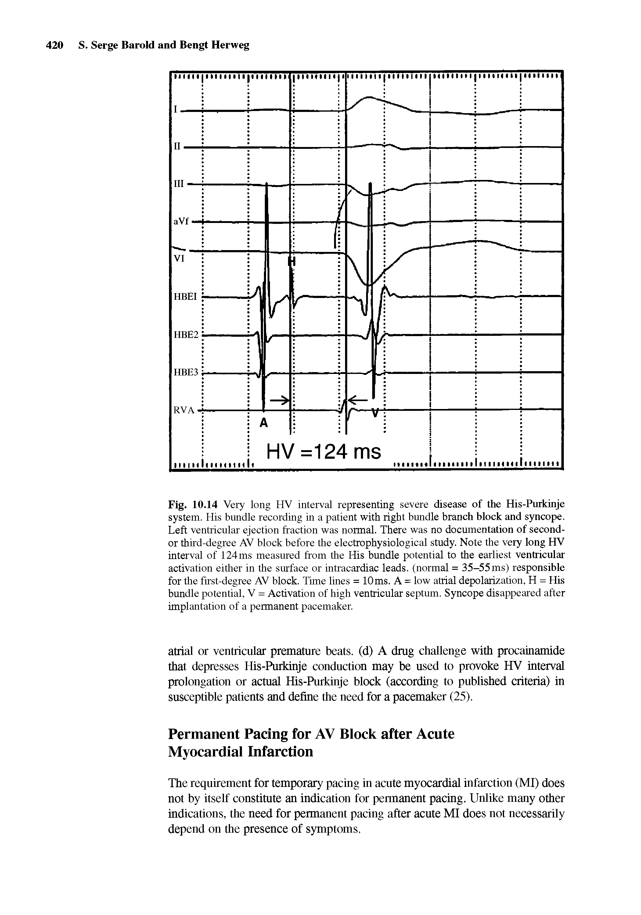 Fig. 10.14 Very long HV interval representing severe disease of the His-Purkinje system. His bnndle recording in a patient with right bundle branch block and syncope. Left ventricular ejection fraction was normal. There was no documentation of seconder third-degree AV block before the electrophysiological study. Note the very long HV interval of 124ms measured from the His bundle potential to the earliest ventricular activation either in the surface or intracardiac leads, (normal = 35-55 ms) responsible for the first-degree AV block. Time fines = 10ms. A = low atrial depolarization, H = His bundle potential, V = Activation of high ventricular septum. Syncope disappeared after implantation of a permanent pacemaker.