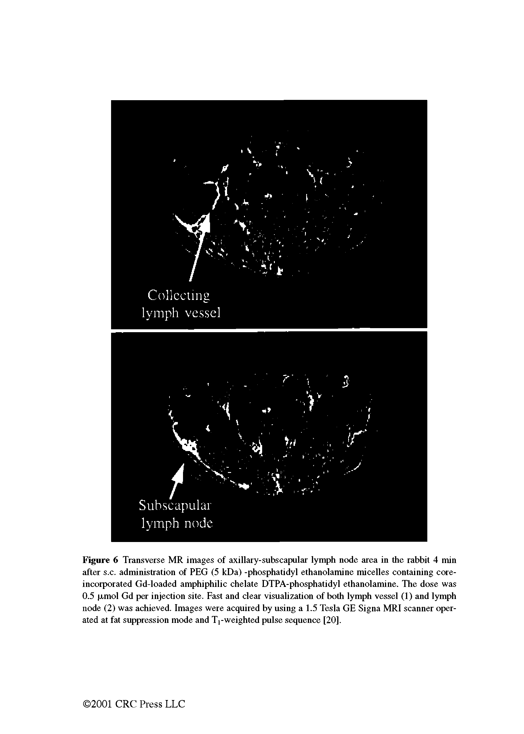 Figure 6 Transverse MR images of axillary-subscapular lymph node area in the rabbit 4 min after s.c. administration of PEG (5 kDa) -phosphatidyl ethanolamine micelles containing coreincorporated Gd-loaded amphiphilic chelate DTPA-phosphatidyl ethanolamine. The dose was 0.5 pmol Gd per injection site. Fast and clear visualization of both lymph vessel (1) and lymph node (2) was achieved. Images were acquired by using a 1.5 Tesla GE Signa MRI scanner operated at fat suppression mode and Ti-weighted pulse sequence [20].
