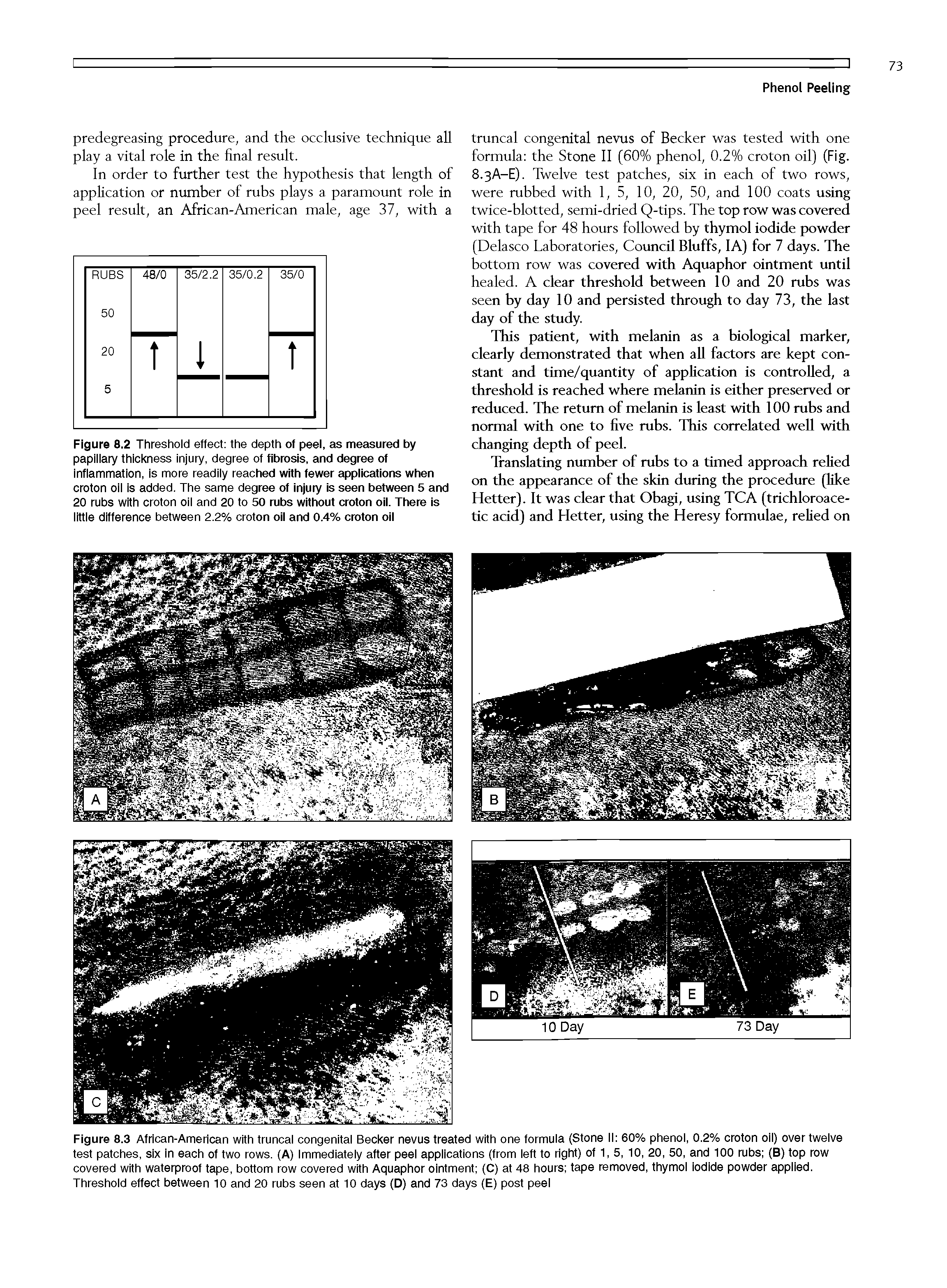 Figure 8.3 African-American with truncal congenital Becker nevus treated with one formula (Stone II 60% phenol, 0.2% croton oil) over twelve test patches, six In each of two rows. (A) Immediately after peel applications (from left to right) of 1, 5, 10, 20, 50, and 100 rubs (B) top row covered with waterproof tape, bottom row covered with Aquaphor ointment (C) at 48 hours tape removed, thymol Iodide powder applied. Threshold effect between 10 and 20 rubs seen at 10 days (D) and 73 days (E) post peel...