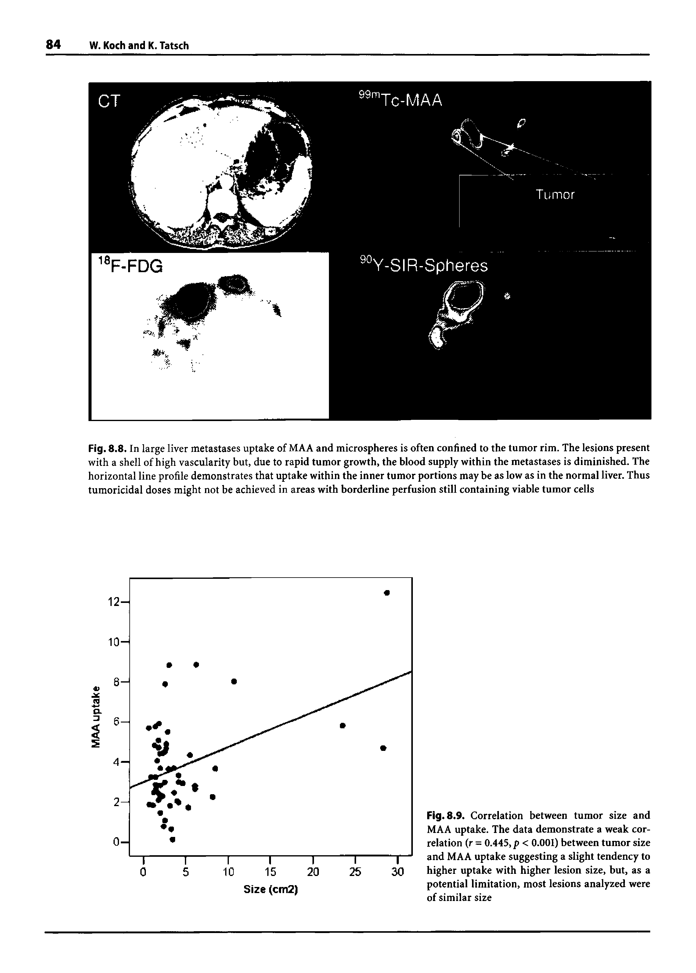 Fig. 8.8. In large liver metastases uptake of MAA and microspheres is often confined to the tumor rim. The lesions present with a shell of high vascularity but, due to rapid tumor growth, the blood supply within the metastases is diminished. The horizontal line profile demonstrates that uptake within the inner tumor portions may be as low as in the normal liver. Thus tumoricidal doses might not be achieved in areas with borderline perfusion still containing viable tumor cells...
