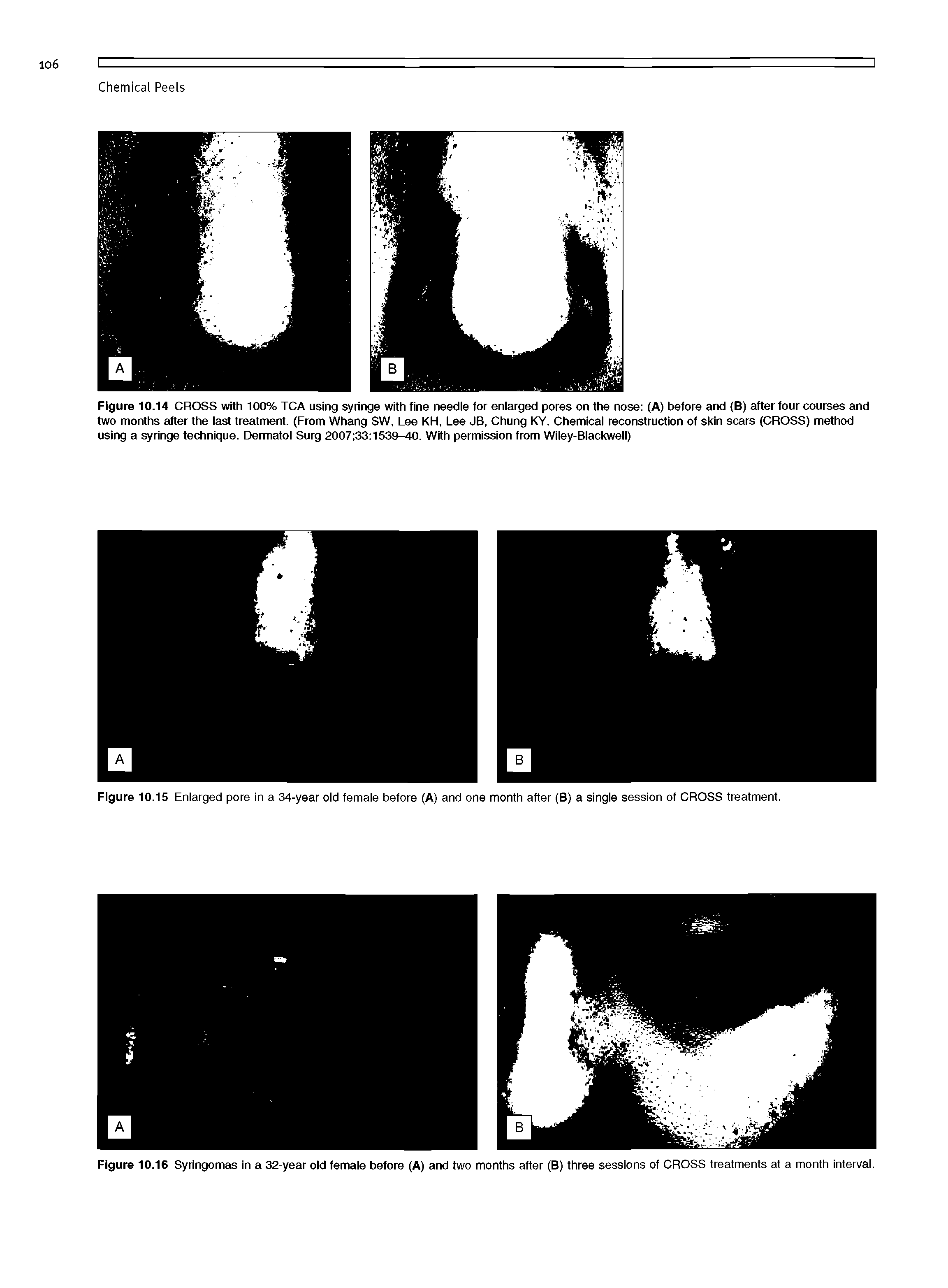 Figure 10.14 CROSS with 100% TCA using syringe with fine needie for eniarged pores on the nose (A) before and (B) after four courses and two months after the last treatment. (From Whang SW, Lee KH, Lee JB, Chung KY. Chemical reconstruction of skin scars (CROSS) method using a syringe technique. Dermatol Surg 2007 33 1539-40. With permission from WIley-Blackwell)...