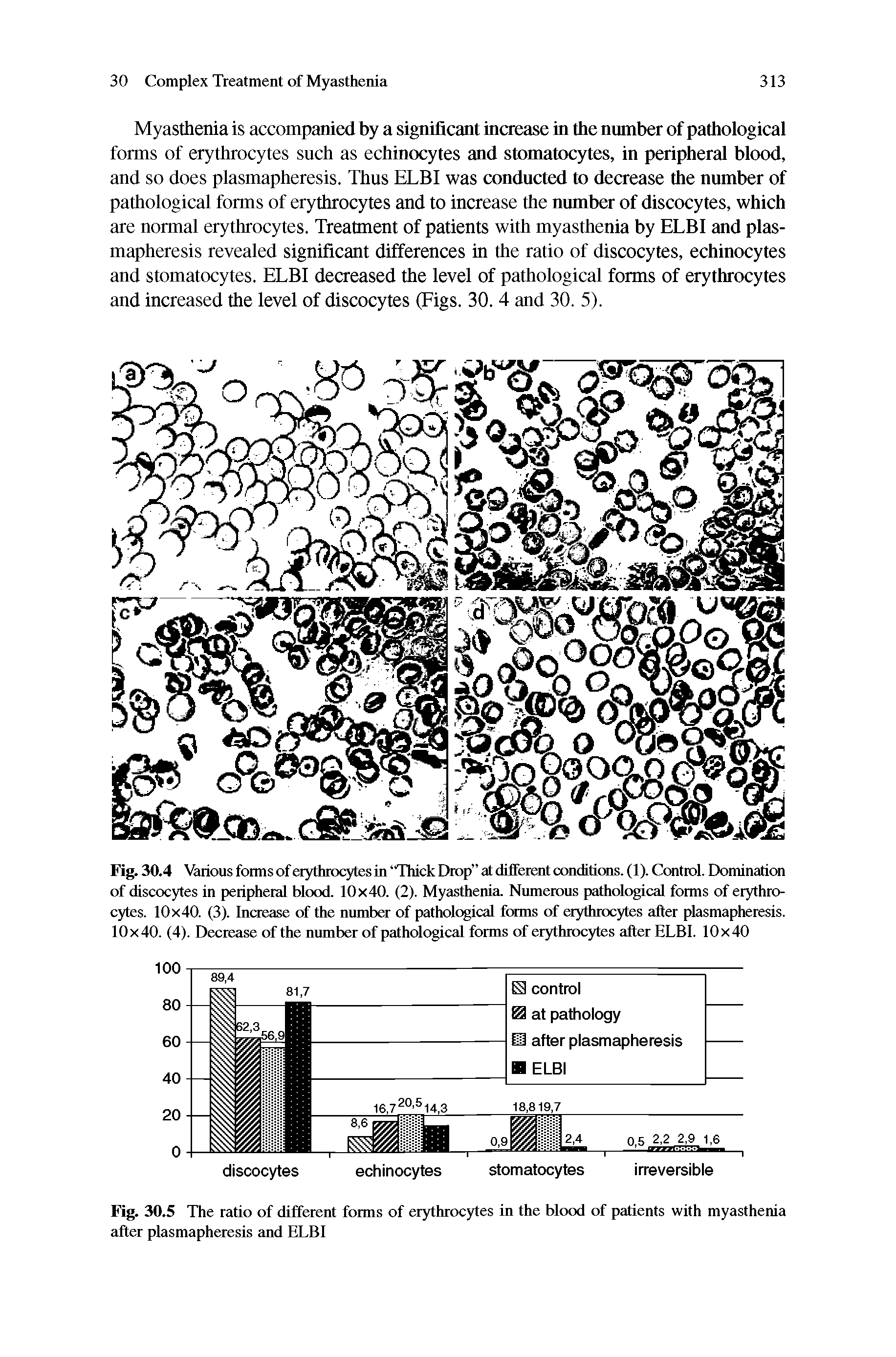 Fig. 30.4 Various forms of erythrocytes in Thick Drop at different conditions. (1). Control. Domination of discocytes in peripheral blood. 10x40. (2). Myasthenia. Nnmerons pathological forms of erythrocytes. 10x40. (3). Increase of the nnmber of pathological forms of erythrocytes after plasmapheresis. 10x40. (4). Decrease of the nnmber of pathological forms of erythrocytes after ELBI. 10x40...