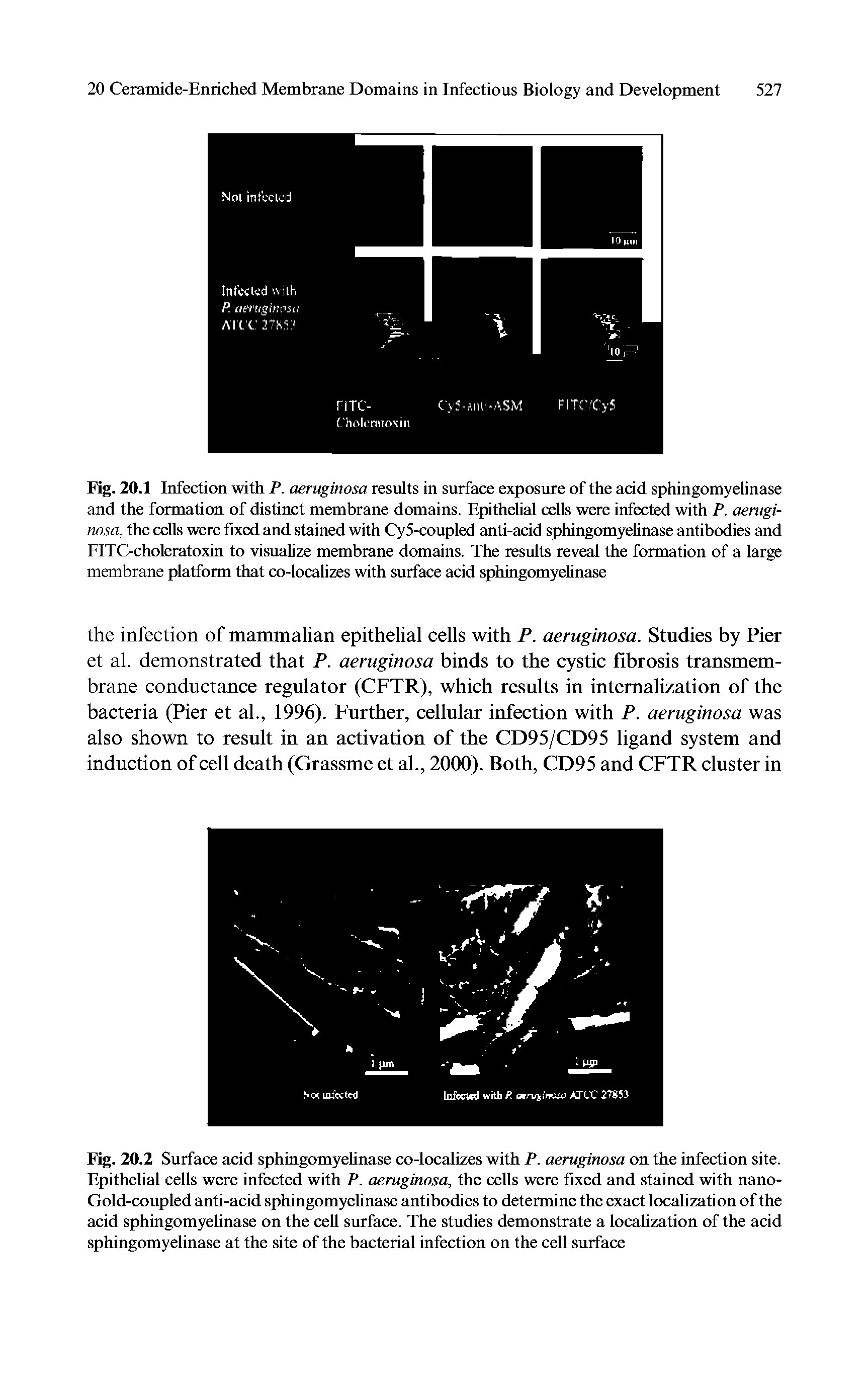 Fig. 20.1 Infection with P. aeruginosa results in surface exposure of the add sphingomyelinase and the formation of distinct membrane domains. Epithehal cells were infected with P. aeruginosa, the cells were fixed and stained with Cy5-coupled anti-acid sphingomyehnase antibodies and FITC-choleratoxin to visualize membrane domains. The results reveal the formation of a large membrane platform that co-localizes with surface acid sphingomyelinase...