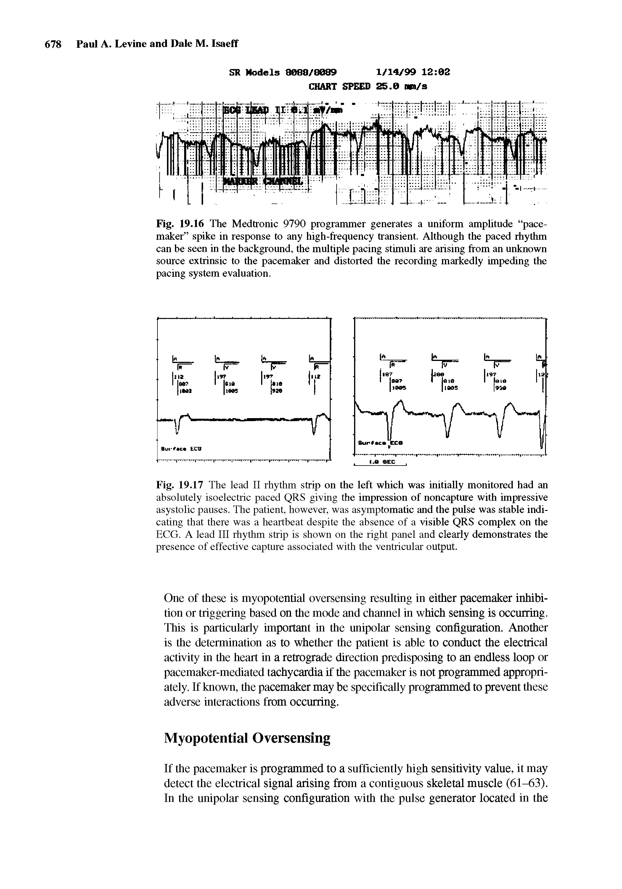 Fig. 19.16 The Medtronic 9790 programmer generates a uniform amplitude pacemaker spike in response to any high-frequency transient. Although the paced rhythm can be seen in the background, the multiple pacing stimuli are arising from an unknown source extrinsic to the pacemaker and distorted the recording markedly impeding the pacing system evaluation.