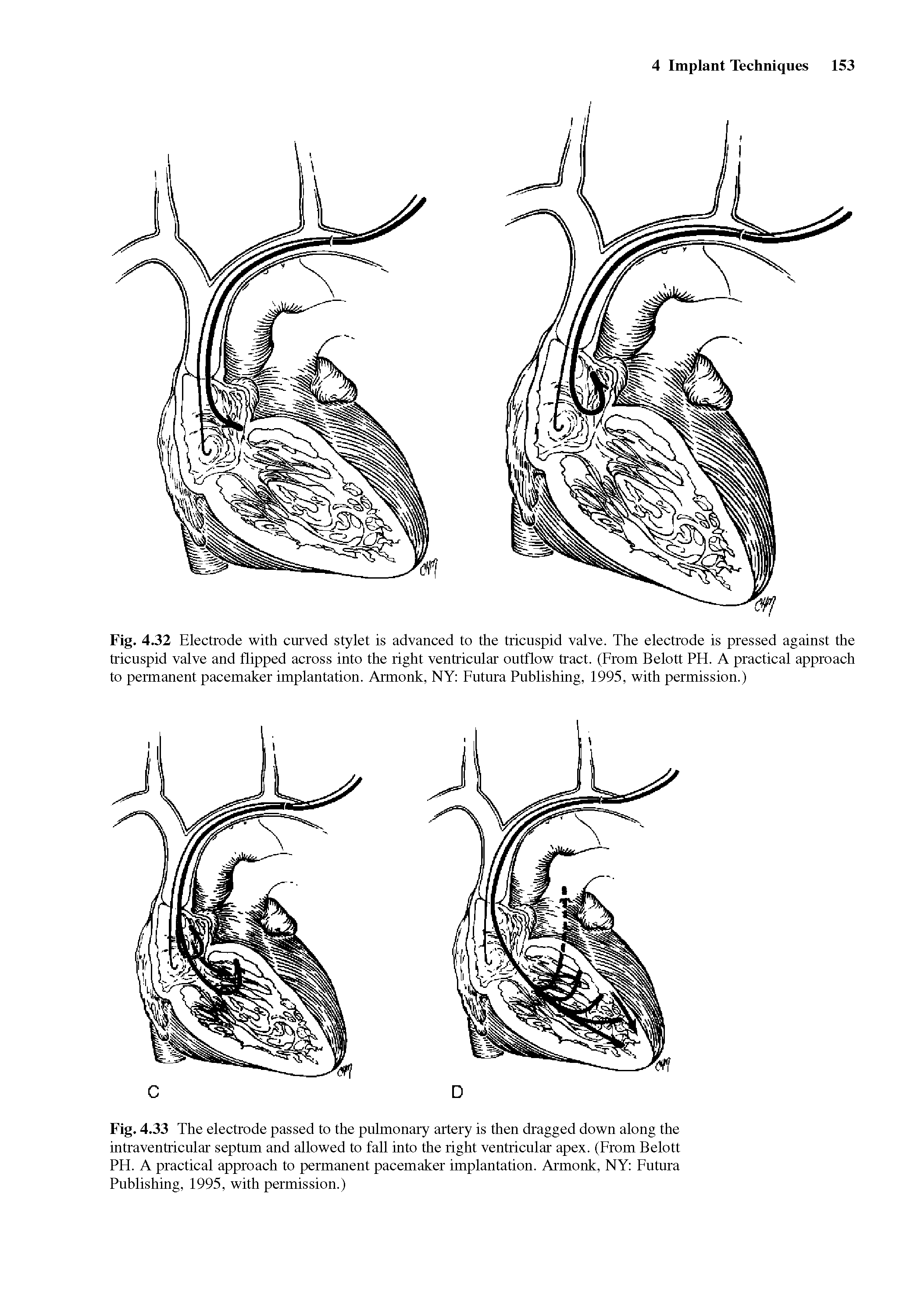 Fig. 4.32 Electrode with curved stylet is advanced to the tricuspid valve. The electrode is pressed against the tricuspid valve and flipped across into the right ventricular outflow tract. (From Belott PH. A practical approach to permanent pacemaker implantation. Armonk, NY Futura Publishing, 1995, with permission.)...