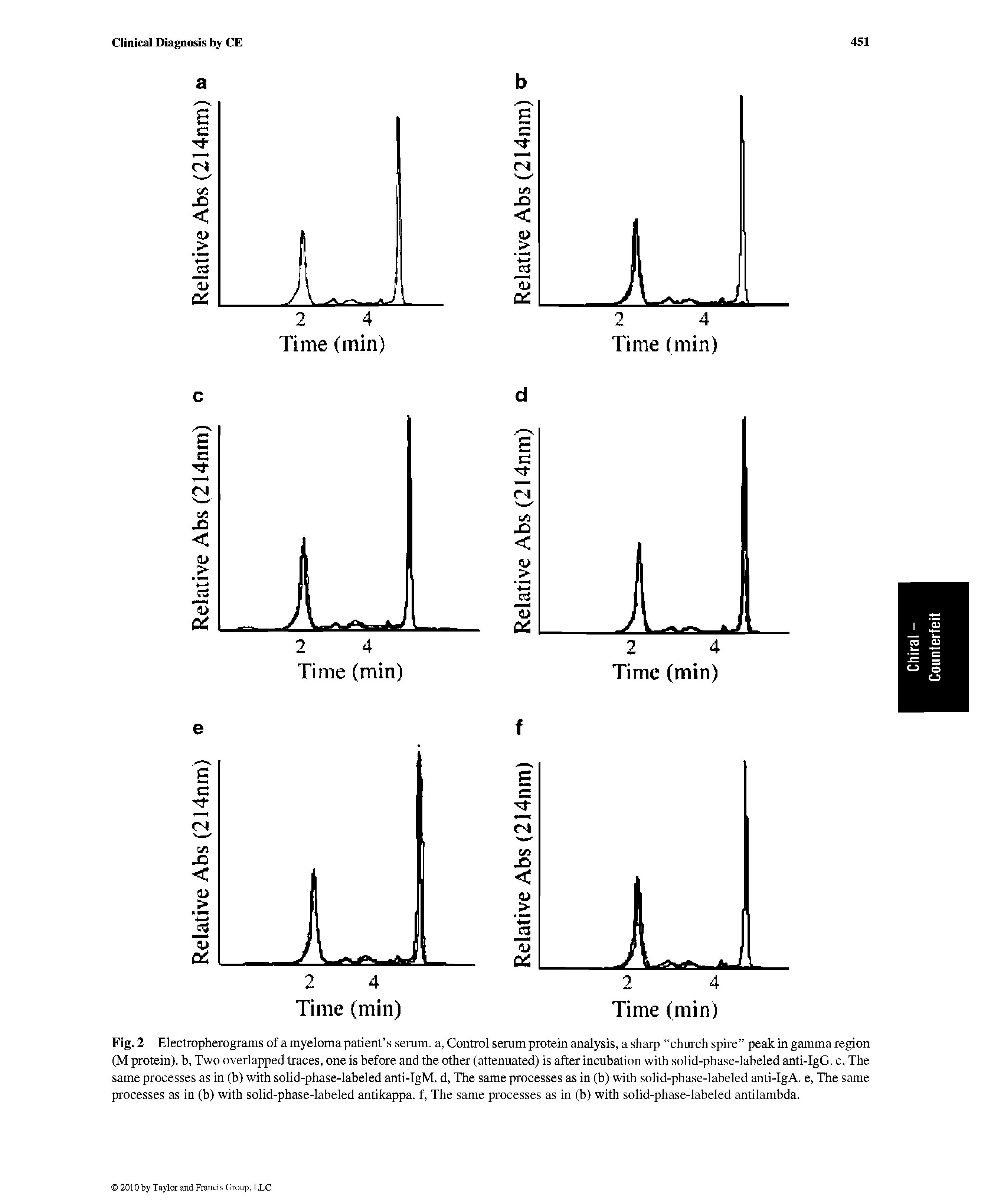 Fig. 2 Electropherograms of a myeloma patient s serum, a, Control serum protein analysis, a sharp church spire peak in gamma region (M protein), b, Two overlapped traces, one is before and the other (attenuated) is after incubation with solid-phase-labeled anti-IgG. c. The same processes as in (b) with solid-phase-labeled anti-IgM. d. The same processes as in (b) with solid-phase-labeled anti-IgA. e. The same processes as in (b) with solid-phase-labeled antikappa, f. The same processes as in (b) with solid-phase-labeled antilambda.