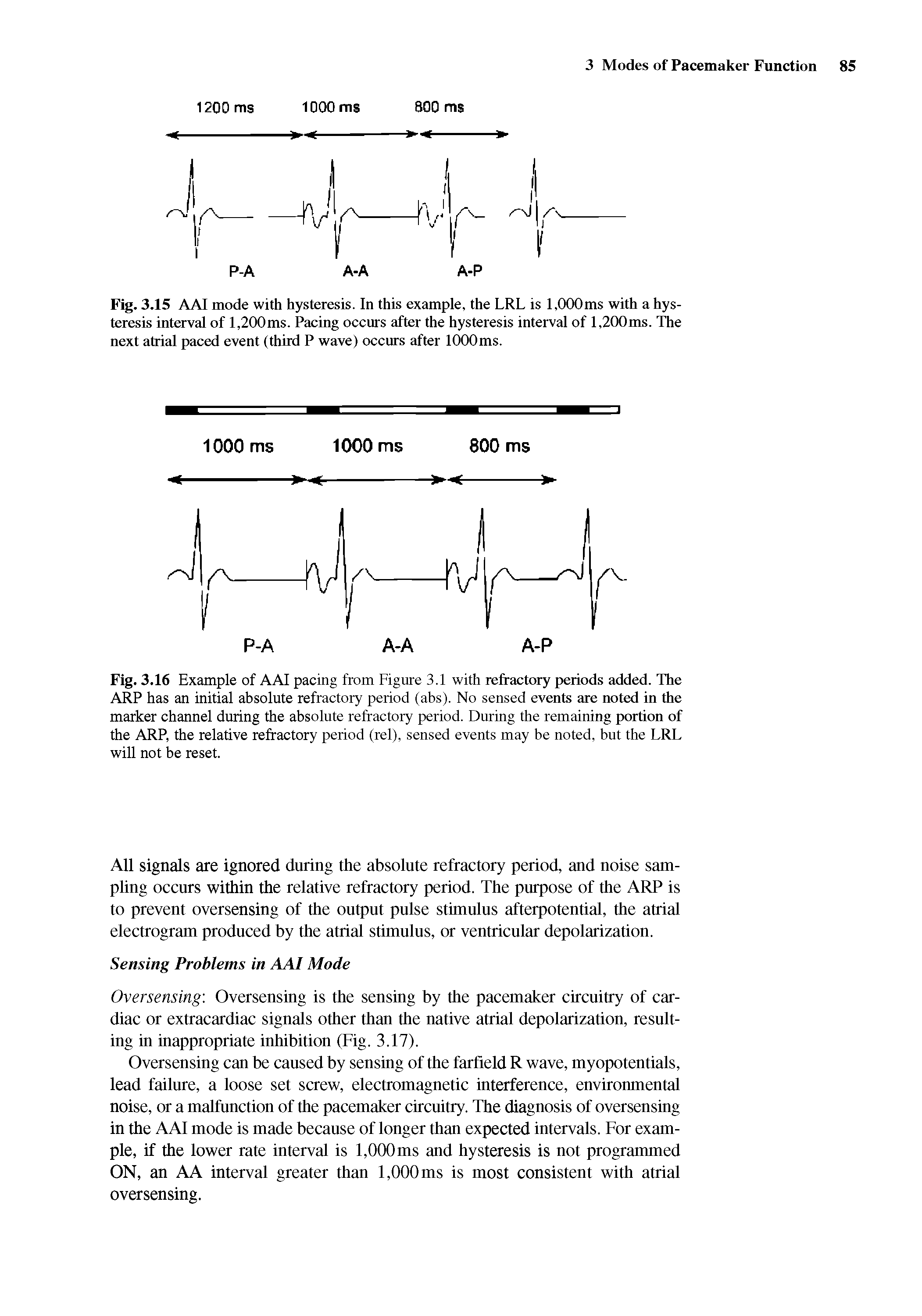 Fig. 3.15 AAI mode with hysteresis. In this example, the LRL is 1,000ms with a hysteresis interval of 1,200ms. Pacing occurs after the hysteresis interval of 1,200ms. The next atrial paced event (third P wave) occurs after 1000ms.