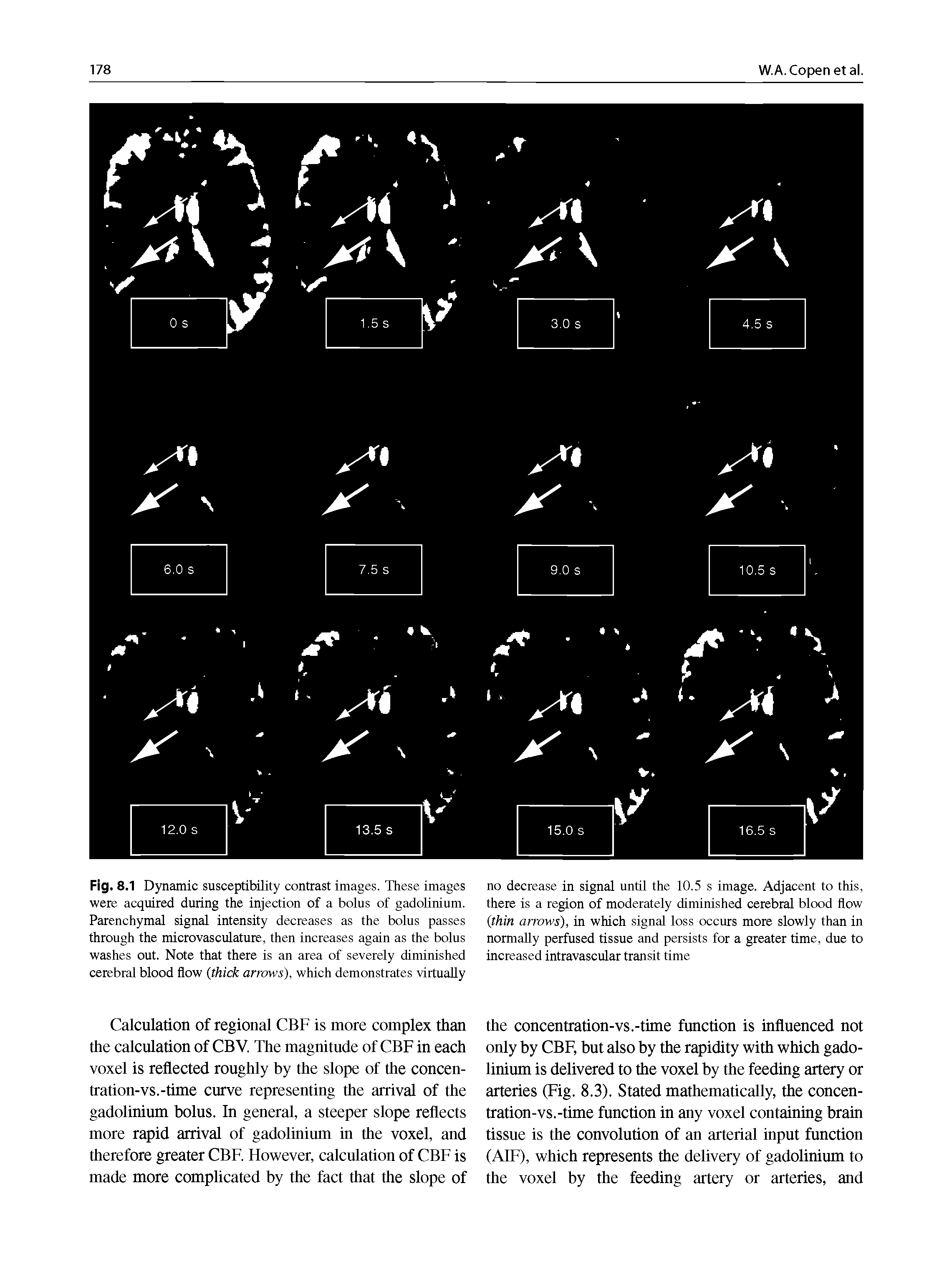 Fig. 8.1 Dynamic susceptibility contrast images. These images were acquired during the injection of a bolus of gadolinium. Parenchymal signal intensity decreases as the bolus passes through the microvasculature, then increases again as the bolus washes out. Note that there is an area of severely diminished cerebral blood flow thick arrows), which demonstrates virtually...