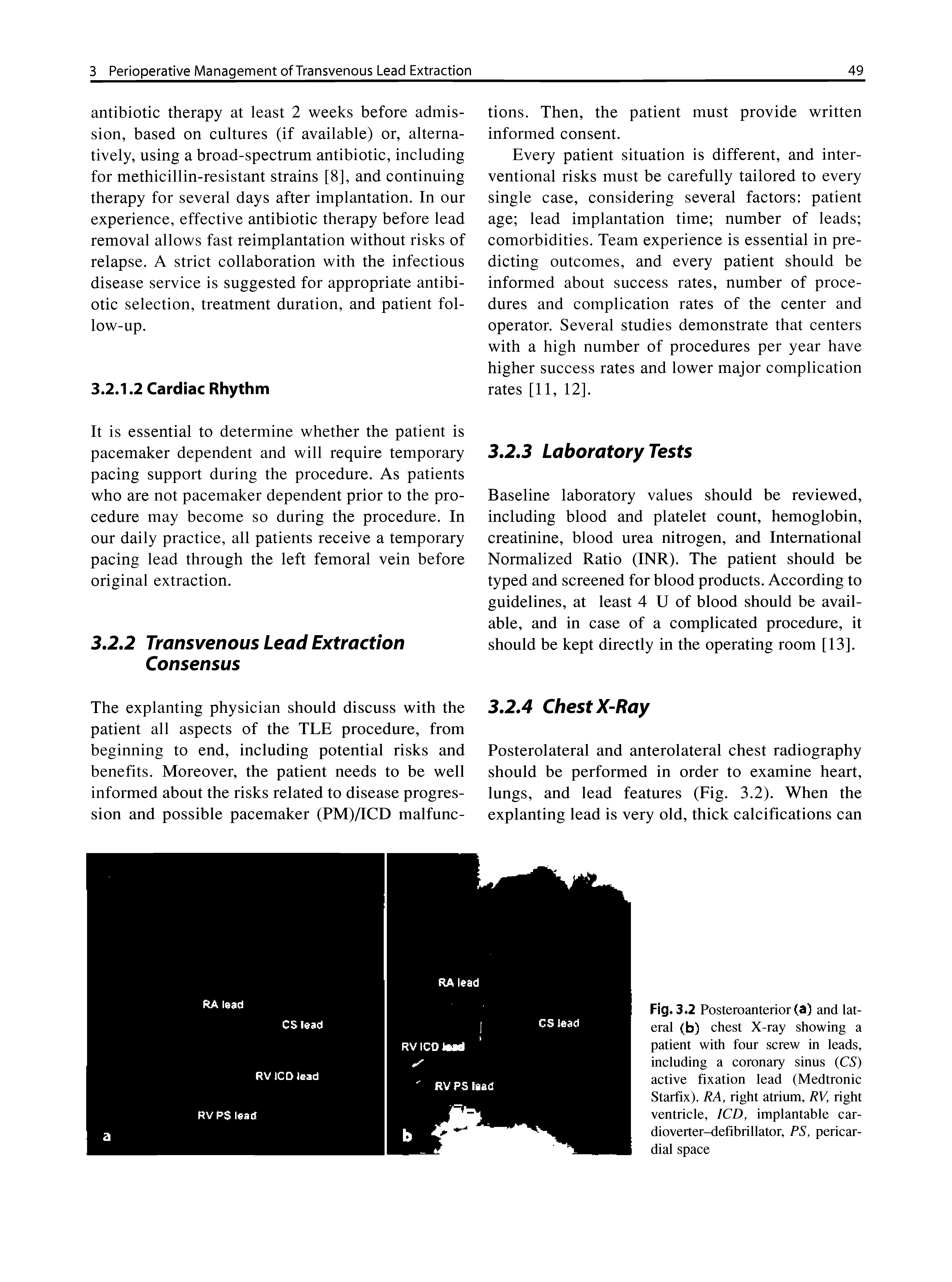Fig. 3 2 Posteroanterior (a) and lateral (b) chest X-ray showing a patient with four screw in leads, including a coronary sinus (CS) active fixation lead (Medtronic Starfix). RA, right atrium, RV, right ventricle, ICD, implantable cardioverter-defibrillator, PS, pericardial space...