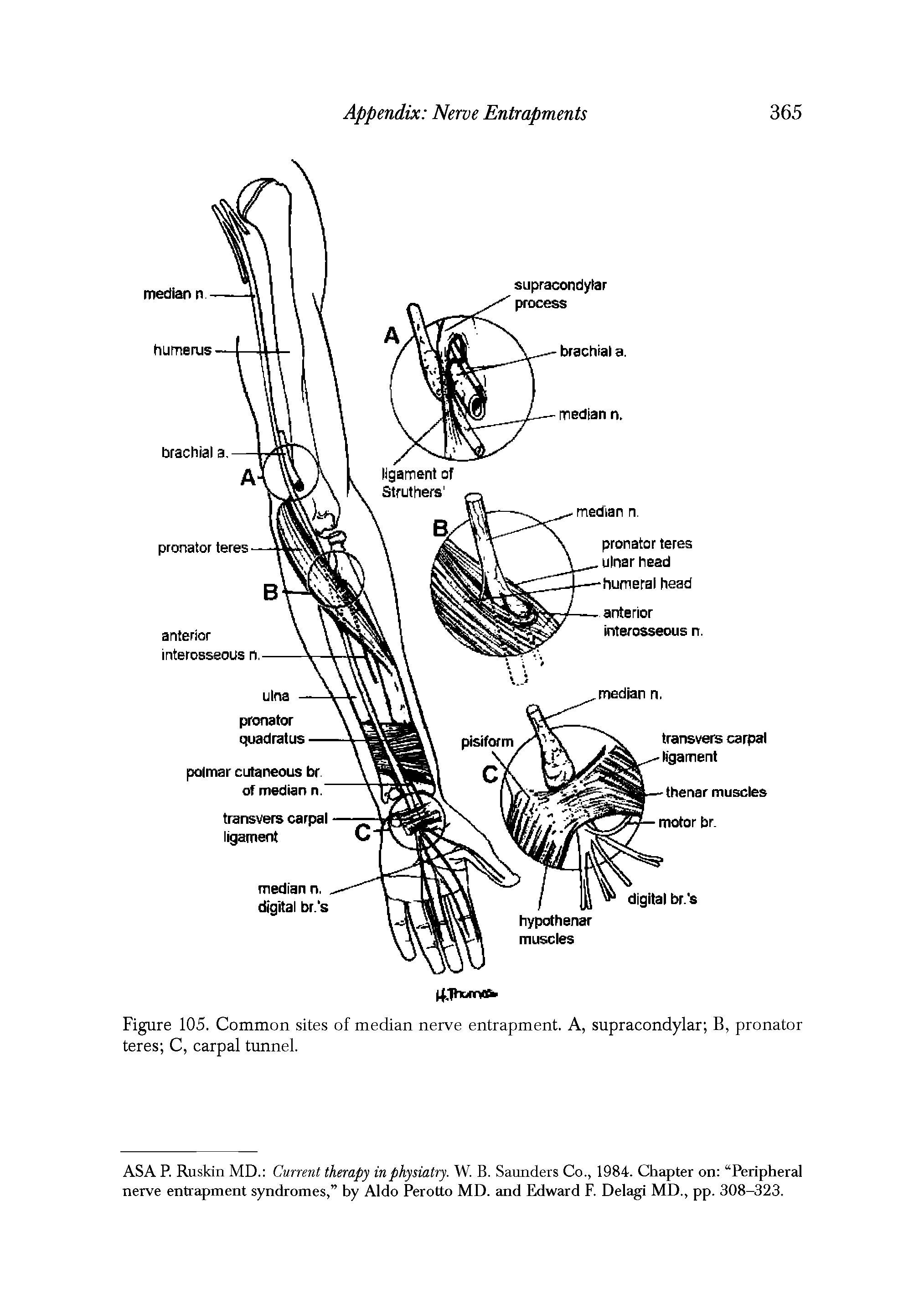 Figure 105. Common sites of median nerve entrapment. A, supracondylar B, pronator teres C, carpal trmnel.