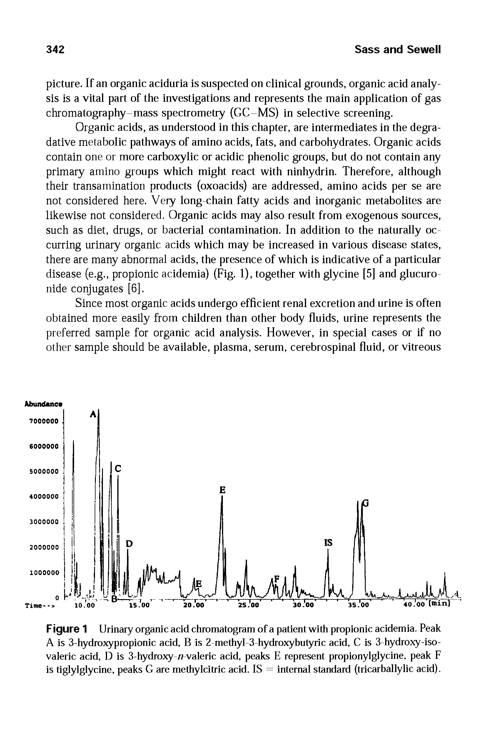 Figure 1 Urinary organic acid chromatogram of a patient with propionic acidemia. Peak A is 3-hydroxypropionic acid, B is 2-methyl-3-hydroxybutyric acid, C is 3-hydroxy-iso-valeric acid, D is 3-hydroxy-/7-vaieric acid, peaks E represent propionylglycine, peak F is tigiyigiycine, peaks G are methyicitric acid. IS = internal standard (tricarballylic acid).