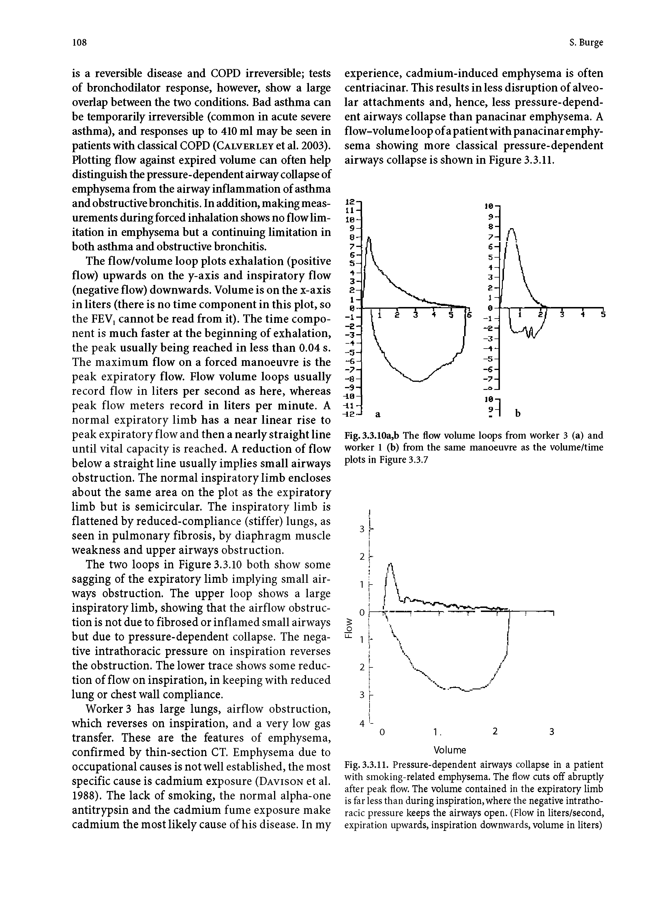 Fig. 3.3.11. Pressure-dependent airways collapse in a patient with smoking-related emphysema. The flow cuts off abruptly after peak flow. The volume contained in the expiratory limb is far less than during inspiration, where the negative intrathoracic pressure keeps the airways open. (Flow in liters/second, expiration upwards, inspiration downwards, volume in liters)...