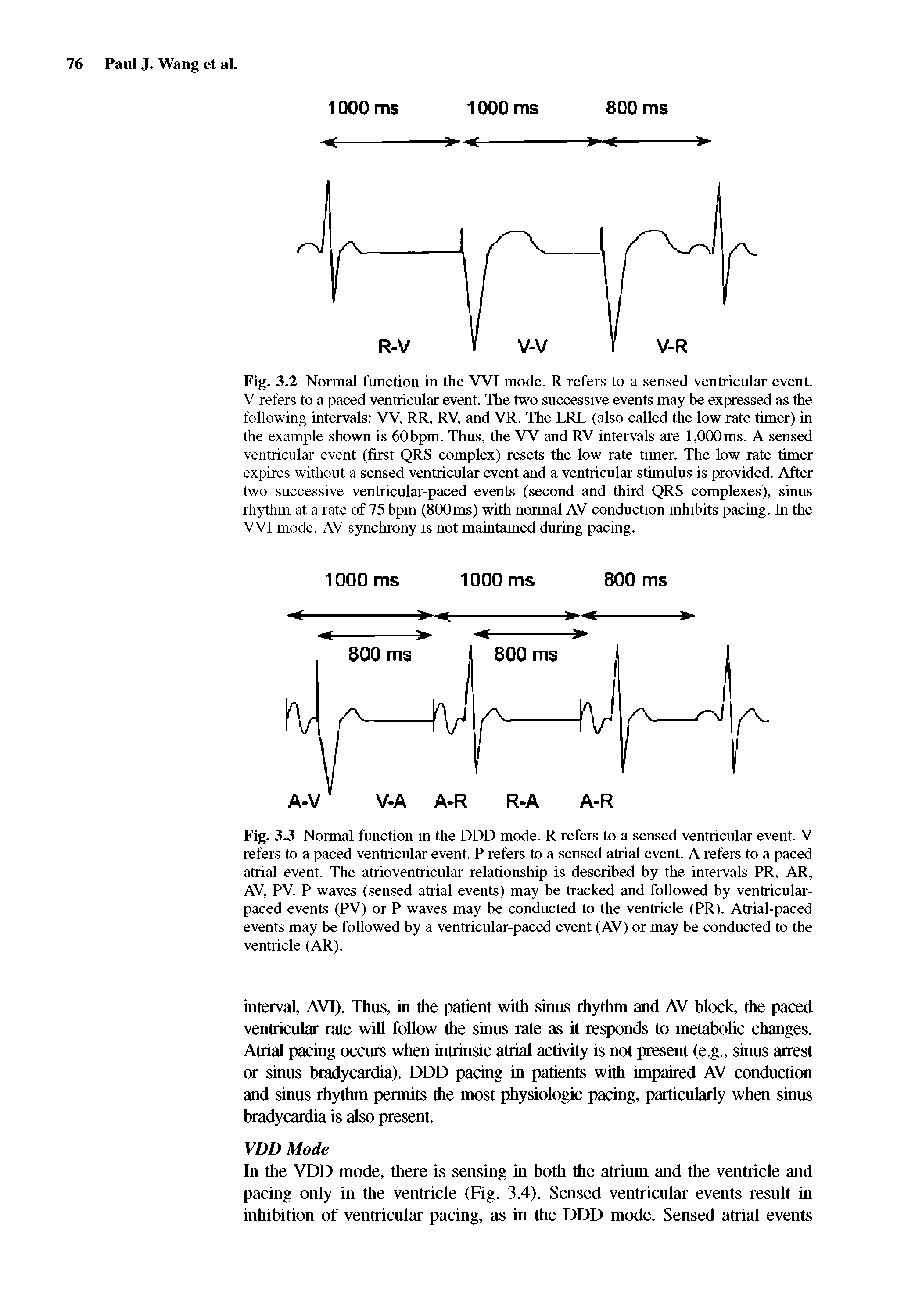 Fig. 3.3 Normal function in the DDD mode. R refers to a sensed ventricular event. V refers to a paced ventricular event. P refers to a sensed atrial event. A refers to a paced atrial event. The atrioventricular relationship is described by the intervals PR, AR, AV, PV. P waves (sensed atrial events) may he tracked and followed by ventricular-paced events (PV) or P waves may be conducted to the ventricle (PR). Atrial-paced events may be followed by a ventricular-paced event (AV) or may be conducted to the ventricle (AR).