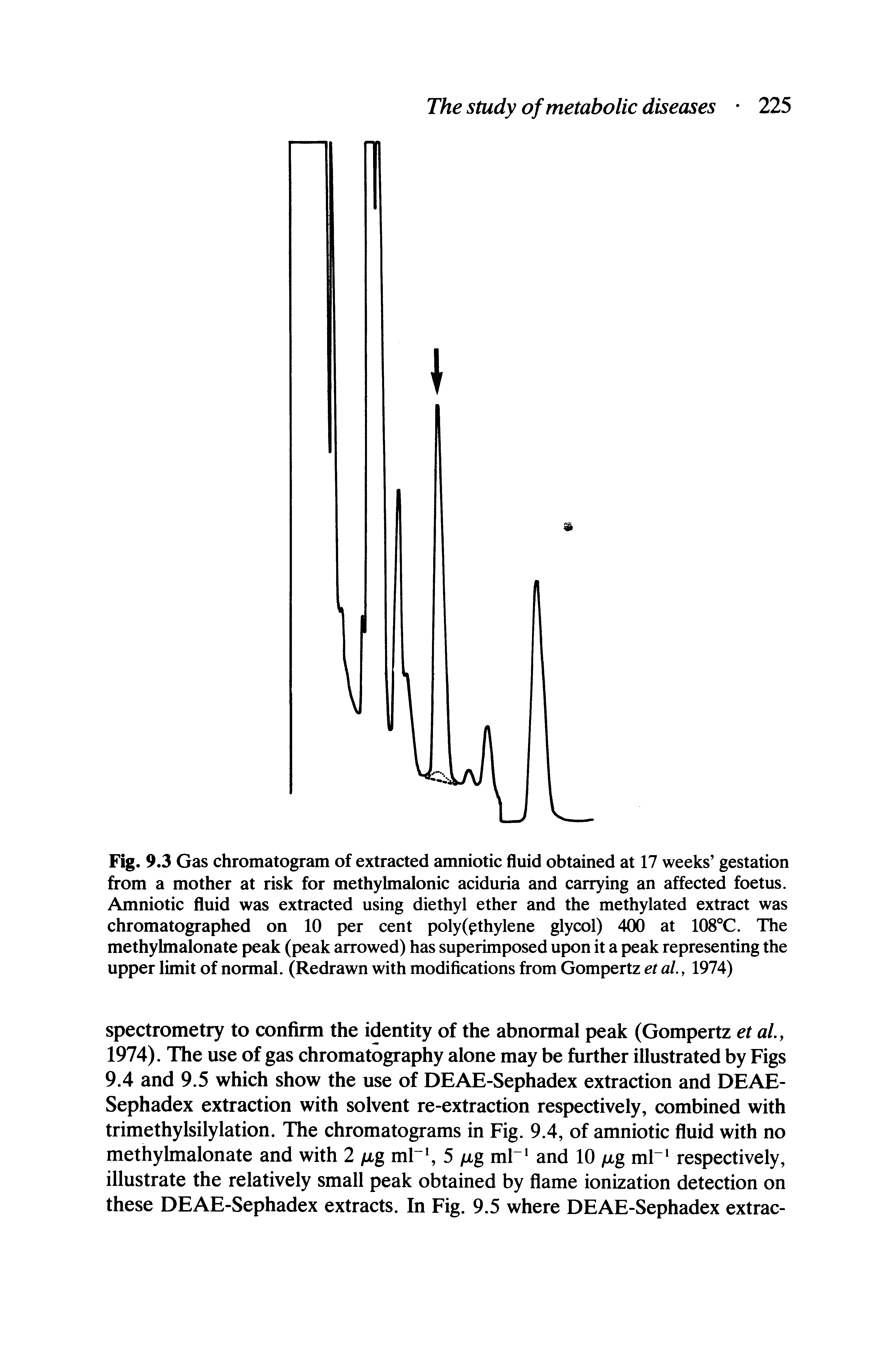 Fig. 9.3 Gas chromatogram of extracted amniotic fluid obtained at 17 weeks gestation from a mother at risk for methylmalonic aciduria and carrying an affected foetus. Amniotic fluid was extracted using diethyl ether and the methylated extract was chromatographed on 10 per cent poly(pthylene glycol) 400 at 108 C. The methylmalonate peak (peak arrowed) has superimposed upon it a peak representing the upper limit of normal. (Redrawn with modifications from Gompertz et al., 1974)...