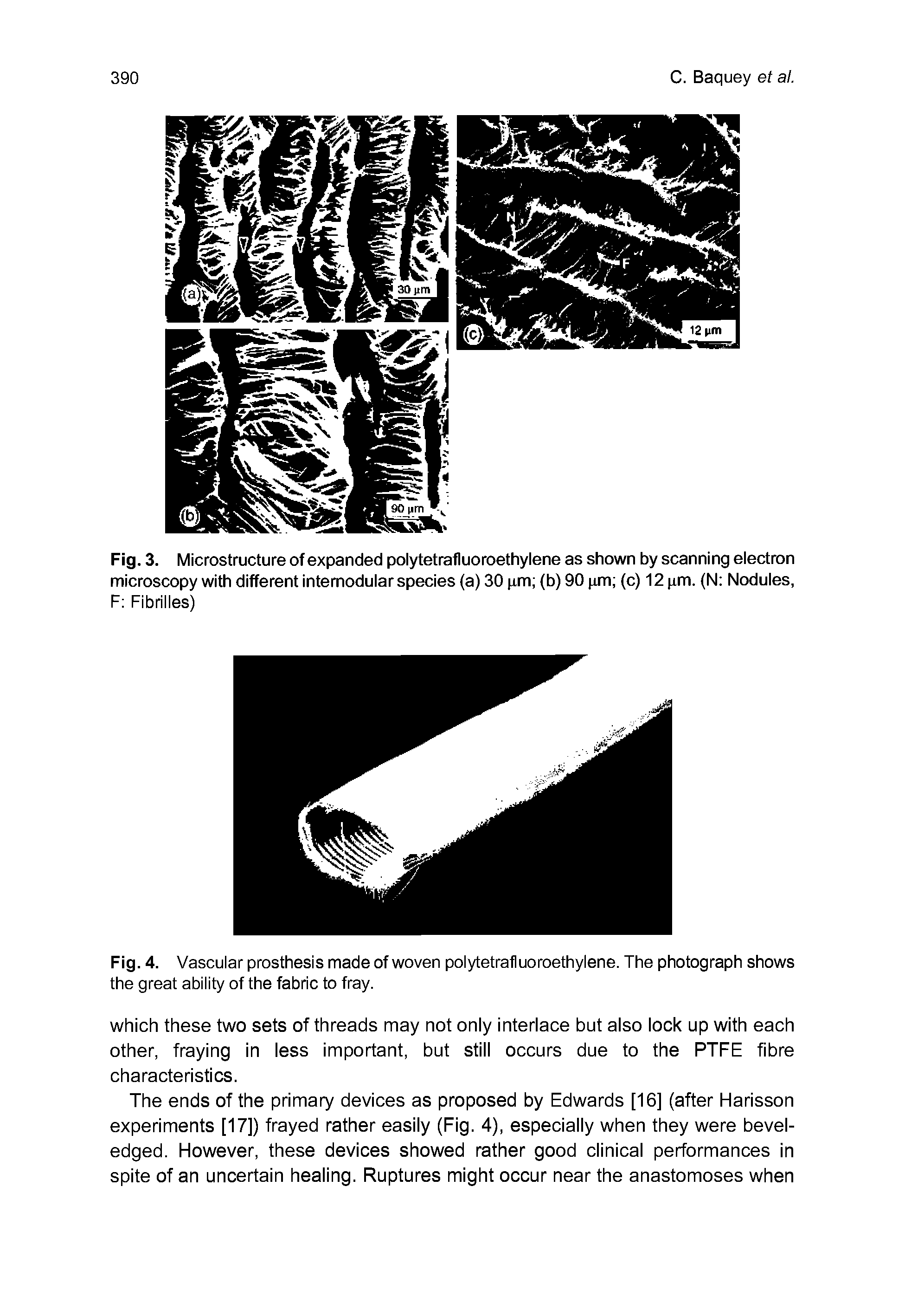 Fig. 3. Microstructure of expanded polytetrafluoroethylene as shown by scanning eiectron microscopy with different intemoduiar species (a) 30 m (b) 90 m (c) 12 nm. (N Noduies, F Fibrilles)...