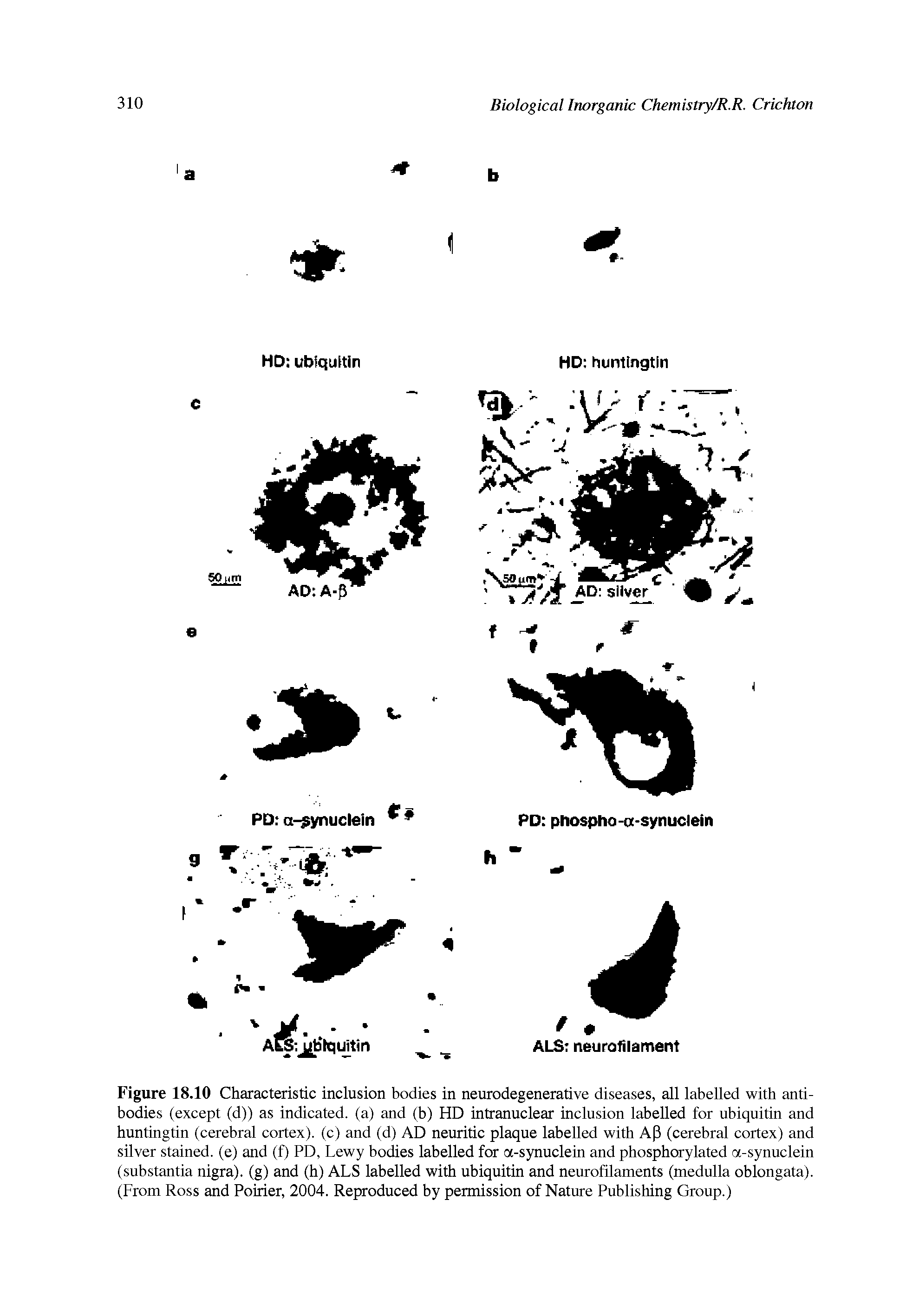 Figure 18.10 Characteristic inclusion bodies in neurodegenerative diseases, all labelled with antibodies (except (d)) as indicated, (a) and (b) HD intranuclear inclusion labelled for ubiquitin and huntingtin (cerebral cortex), (c) and (d) AD neuritic plaque labelled with AP (cerebral cortex) and silver stained, (e) and (f) PD, Lewy bodies labelled for ot-synuclein and phosphorylated a-synuclein (substantia nigra), (g) and (h) ALS labelled with ubiquitin and neurofilaments (medulla oblongata). (From Ross and Poirier, 2004. Reproduced by permission of Nature Publishing Group.)...