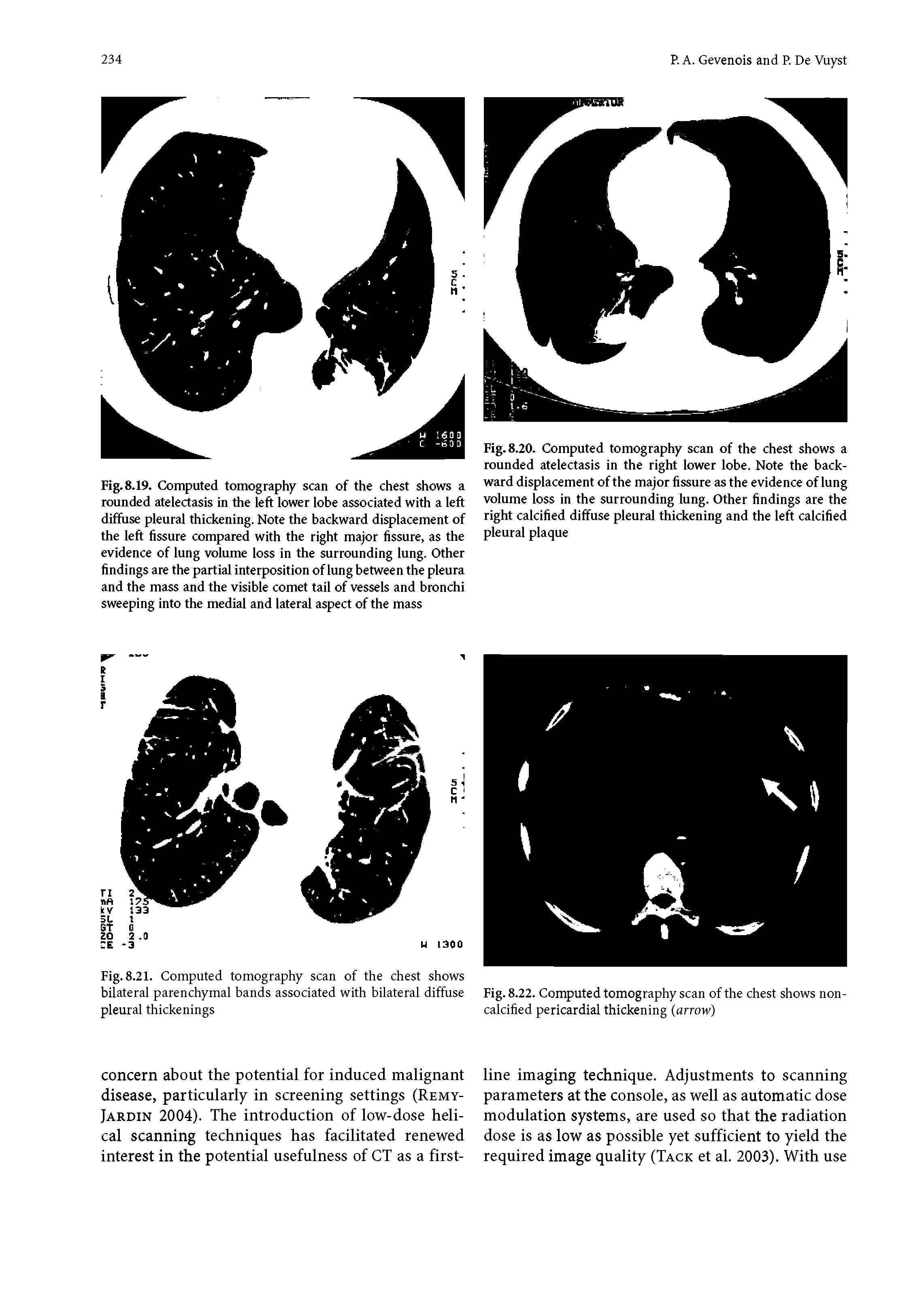 Fig. 8.19. Computed tomography scan of the chest shows a rounded atelectasis in the left lower lobe associated with a left diffuse pleural thickening. Note the backward displacement of the left fissure compared with the right major fissure, as the evidence of lung volume loss in the surrounding lung. Other findings are the partial interposition of lung between the pleura and the mass and the visible comet tail of vessels and bronchi sweeping into the medial and lateral aspect of the mass...