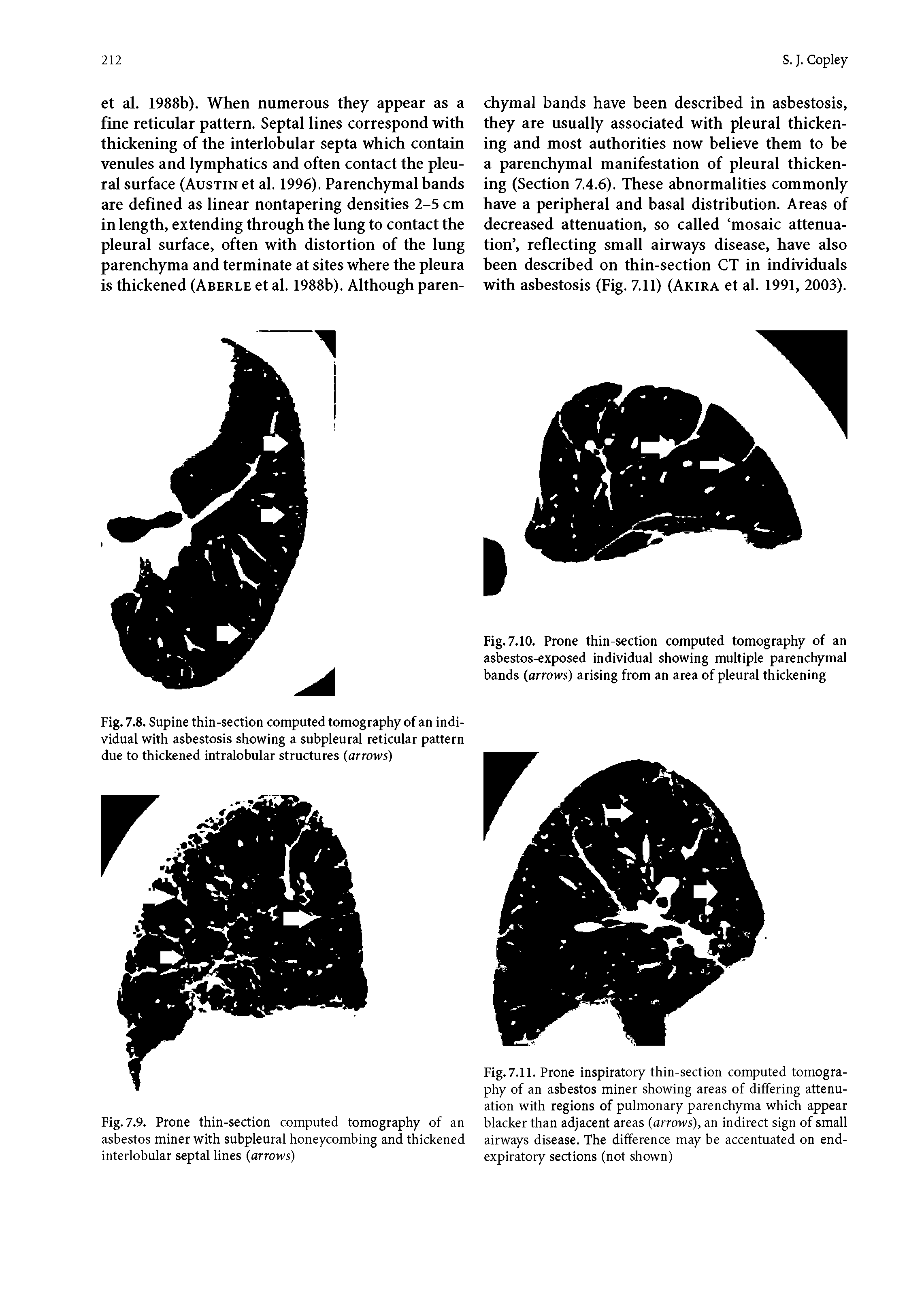 Fig. 7.11. Prone inspiratory thin-section computed tomography of an asbestos miner showing areas of differing attenuation with regions of pulmonary parenchyma which appear blacker than adjacent areas (arrows), an indirect sign of small airways disease. The difference may be accentuated on end-expiratory sections (not shown)...