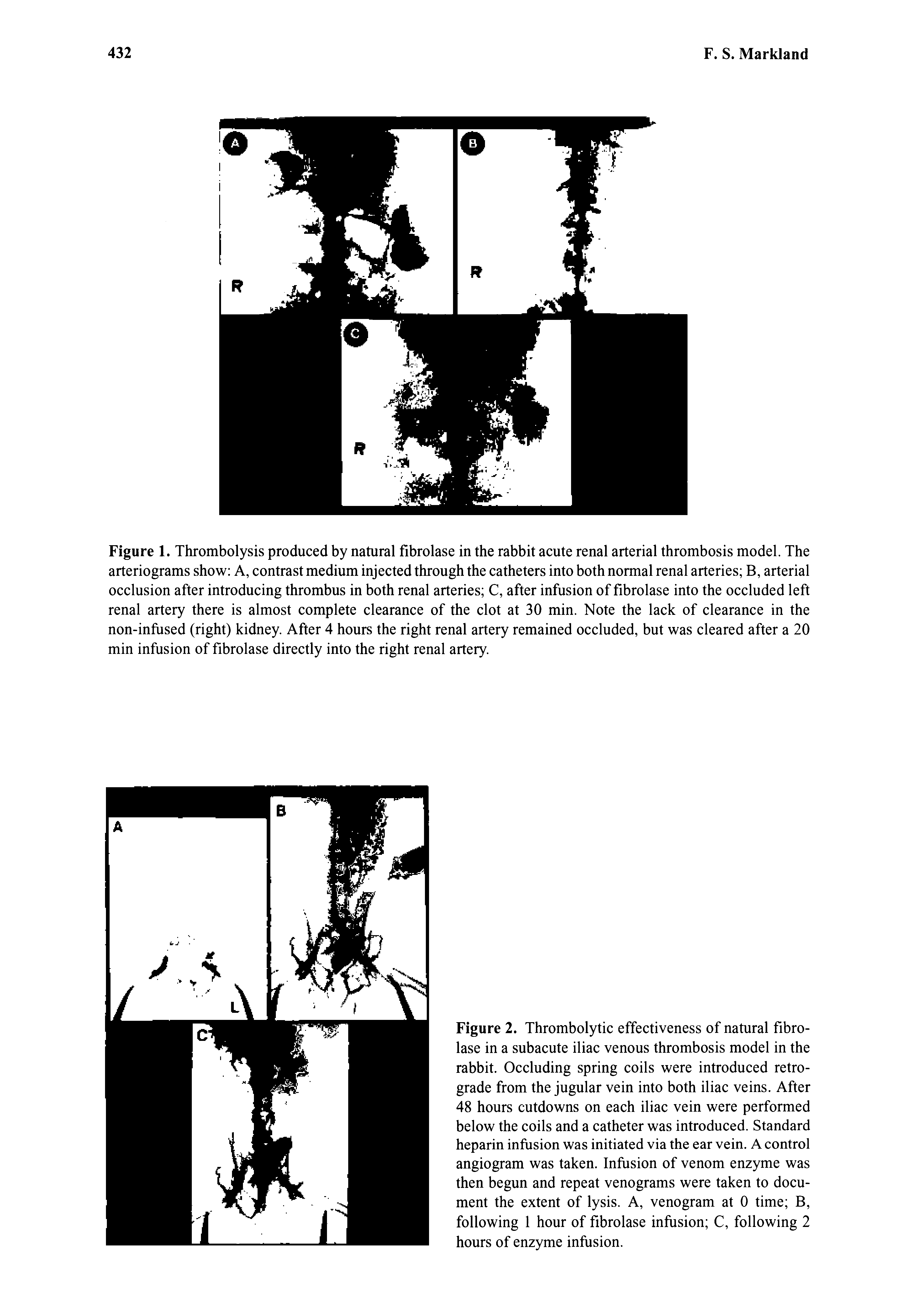 Figure 1. Thrombolysis produced by natural fibrolase in the rabbit acute renal arterial thrombosis model. The arteriograms show A, contrast medium injected through the catheters into both normal renal arteries B, arterial occlusion after introducing thrombus in both renal arteries C, after infusion of fibrolase into the occluded left renal artery there is almost complete clearance of the clot at 30 min. Note the lack of clearance in the non-infused (right) kidney. After 4 hours the right renal artery remained occluded, but was cleared after a 20 min infusion of fibrolase directly into the right renal artery.