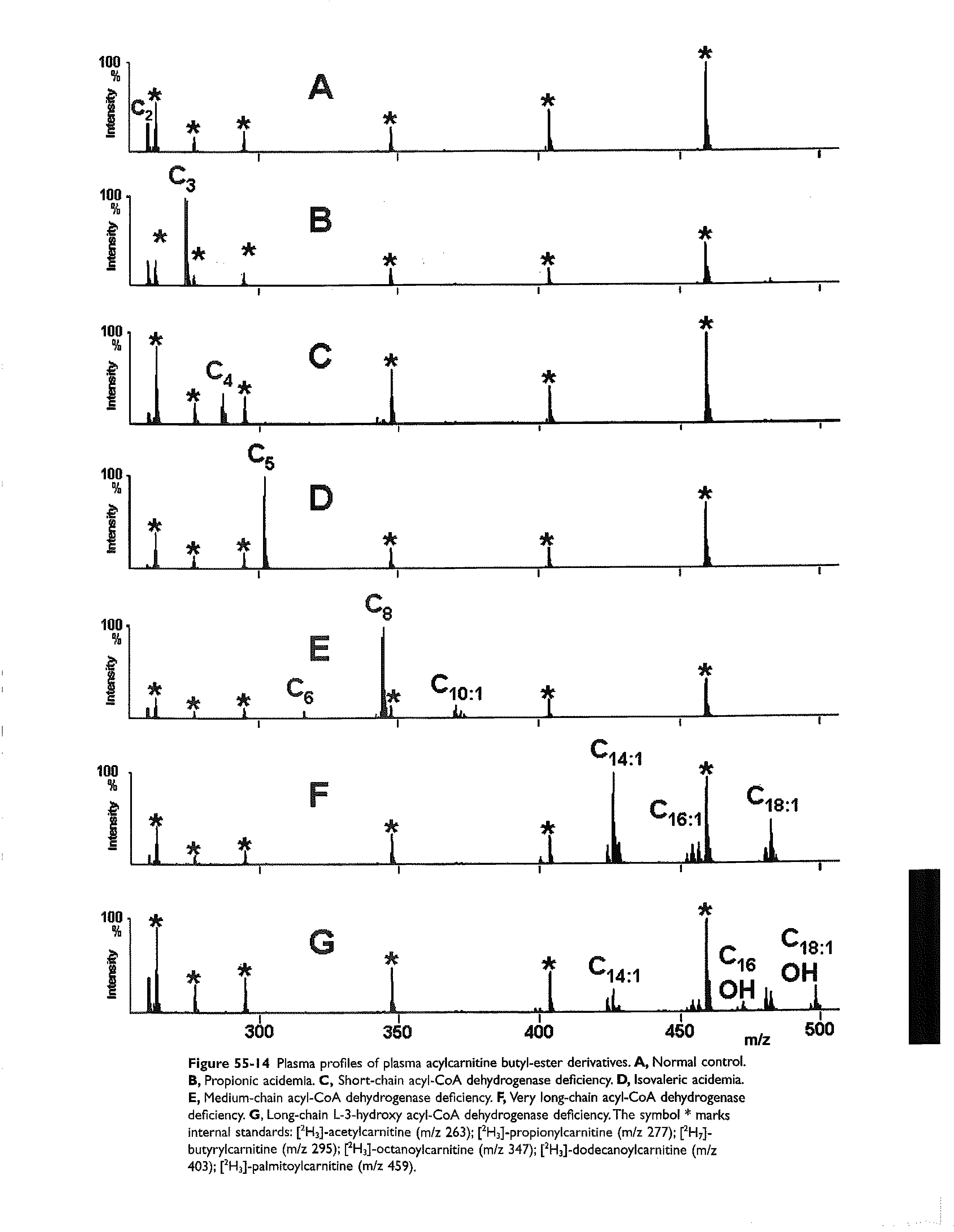 Figure 55-14 Plasma profiles of plasma acylcarnitine butyl-ester derivatives. A, Normal control. B, Propionic acidemia. C, Short-chain acyl-CoA dehydrogenase deficiency. D, Isovaleric acidemia. E, Medium-chain acyl-CoA dehydrogenase deficiency. F, Very long-chain acyl-CoA dehydrogenase deficiency. G, Long-chain L-3-hydroxy acyl-CoA dehydrogenase deficiency.The symbol marks internal standards [ Hjj-acetylcarnitine (m/z 263) [ HaJ-propionylcarnitine (m/z 277) fH ]-butyrylcarnitlne (m/z 295) pHal-octanoylcarnitine (m/z 347) [ Haj-dodecanoylcarnltine (m/z 403) [ Haj-palmitoy I carnitine (m/z 459).