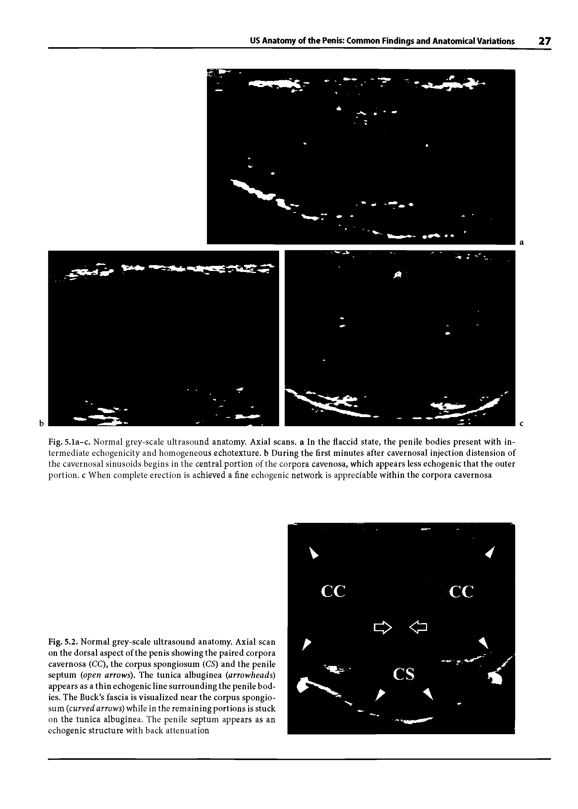 Fig. 5.2. Normal grey-scale ultrasound anatomy. Axial scan on the dorsal aspect of the penis showing the paired corpora cavernosa (CC), the corpus spongiosum (CS) and the penile septum (open arrows). The tunica albuginea (arrowheads) appears as a thin echogenic line surrounding the penile bodies. The Buck s fascia is visualized near the corpus spongiosum (curved arrows) while in the remaining portions is stuck on the tunica albuginea. The penile septum appears as an echogenic structure with back attenuation...