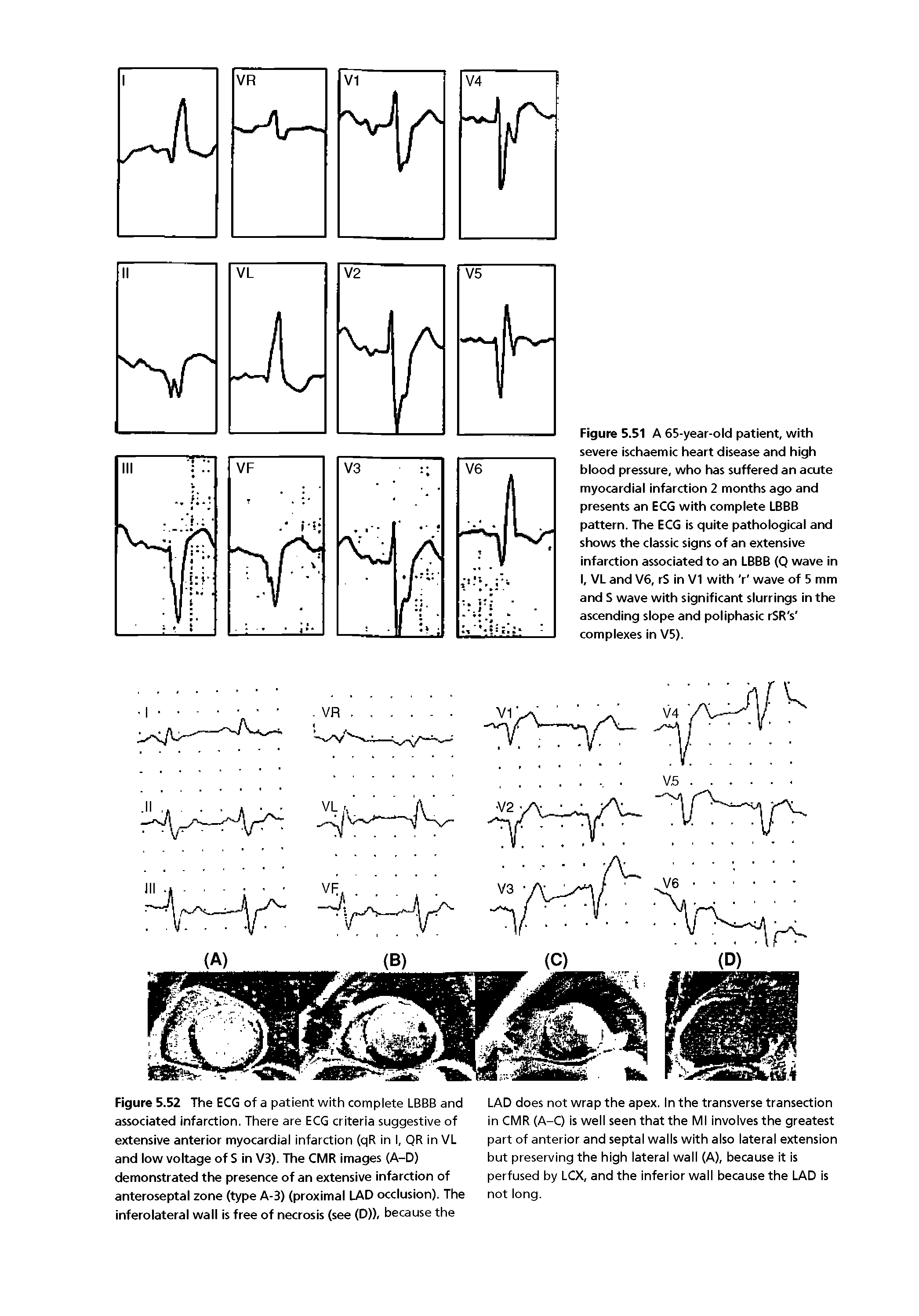 Figure 5.52 The ECG of a patient with complete LBBB and associated infarction. There are ECG criteria suggestive of extensive anterior myocardial infarction (qR in I, QR in VL and low voltage of S in V3). The CMR images (A-D) demonstrated the presence of an extensive infarction of anteroseptal zone (type A-3) (proximal LAD occlusion). The inferolateral wall is free of necrosis (see (D)), because the...