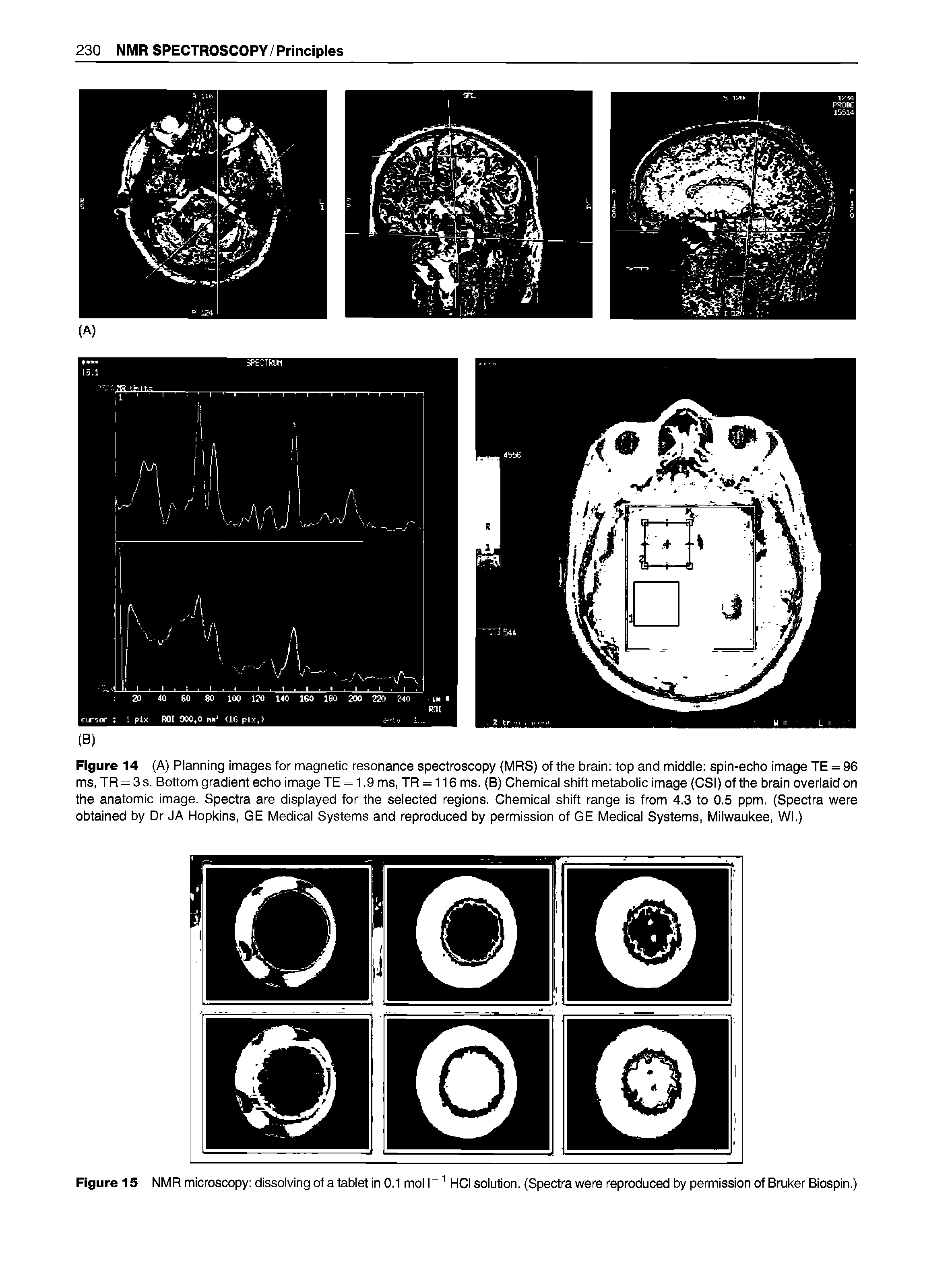 Figure 14 (A) Planning images for magnetic resonance spectroscopy (MRS) of the brain top and middle spin-echo image TE = 96 ms, TR = 3 s. Bottom gradient echo image TE = 1.9 ms, TR = 116 ms. (B) Chemical shift metabolic image (CSI) of the brain overlaid on the anatomic image. Spectra are displayed for the selected regions. Chemical shift range is from 4.3 to 0.5 ppm. (Spectra were obtained by Dr JA Hopkins, GE Medical Systems and reproduced by permission of GE Medical Systems, Milwaukee, Wl.)...