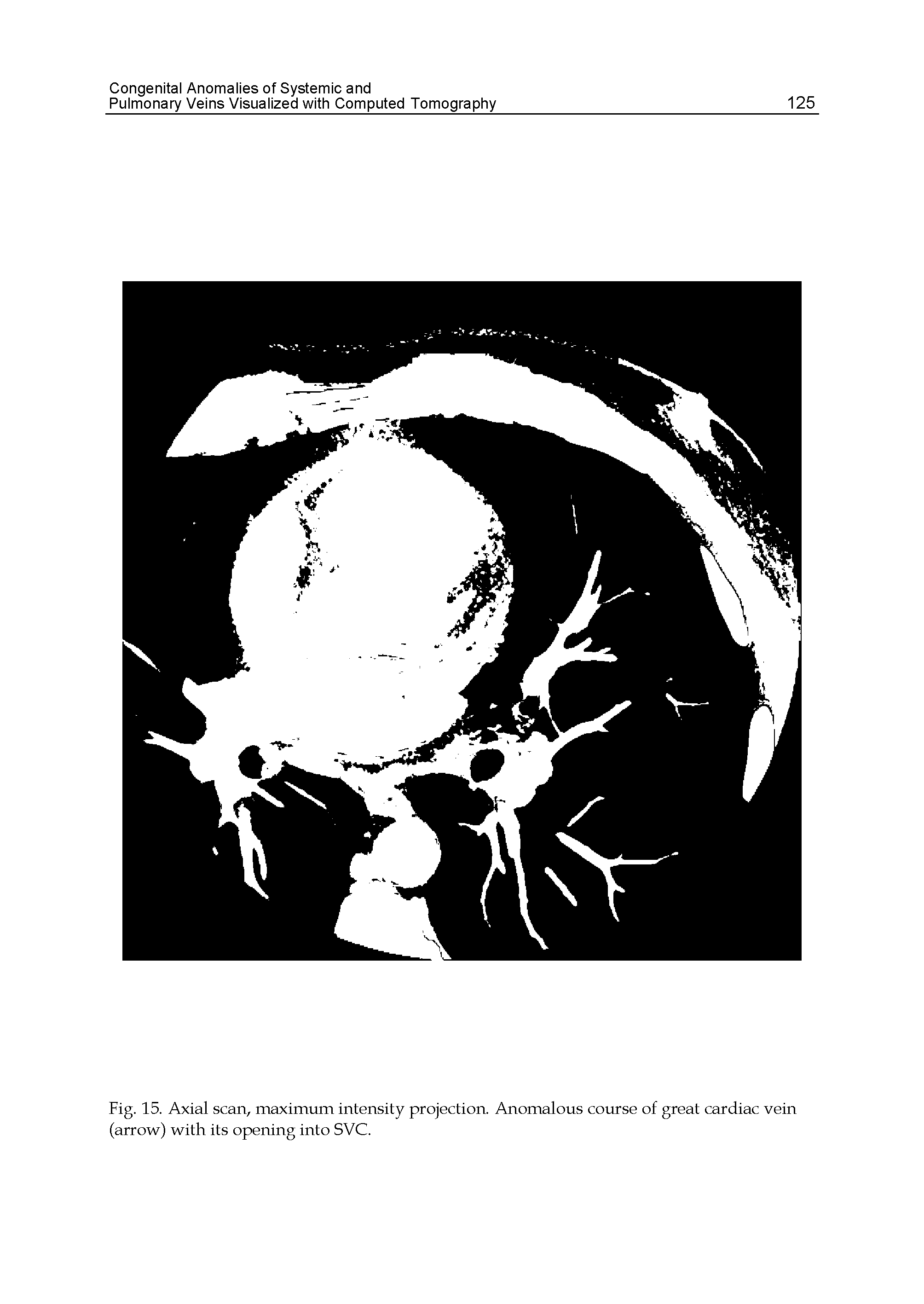 Fig. 15. Axial scan, maximum intensity projection. Anomalous course of great cardiac vein (arrow) with its opening into SVC.