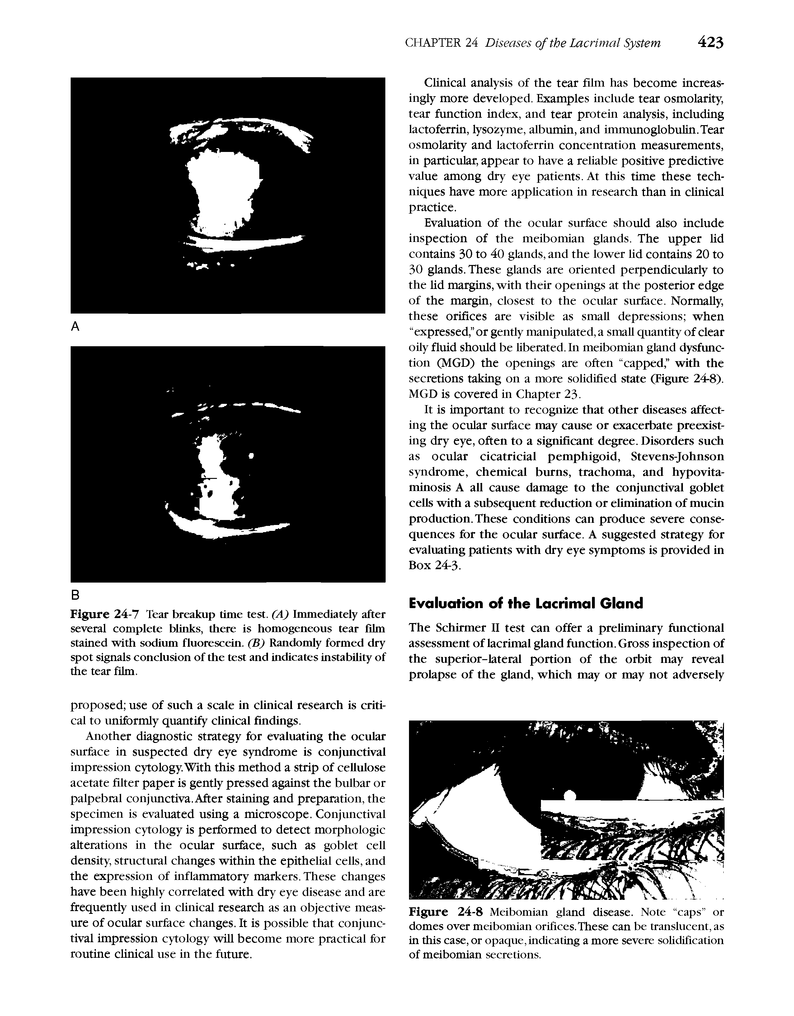 Figure 24-7 Tear breakup time test. (A) Immediately after several complete bUnks, there is homogeneous tear film stained with sodium fluorescein. (B) Randomly formed dry spot signals conclusion of the test and indicates instability of the tear film.