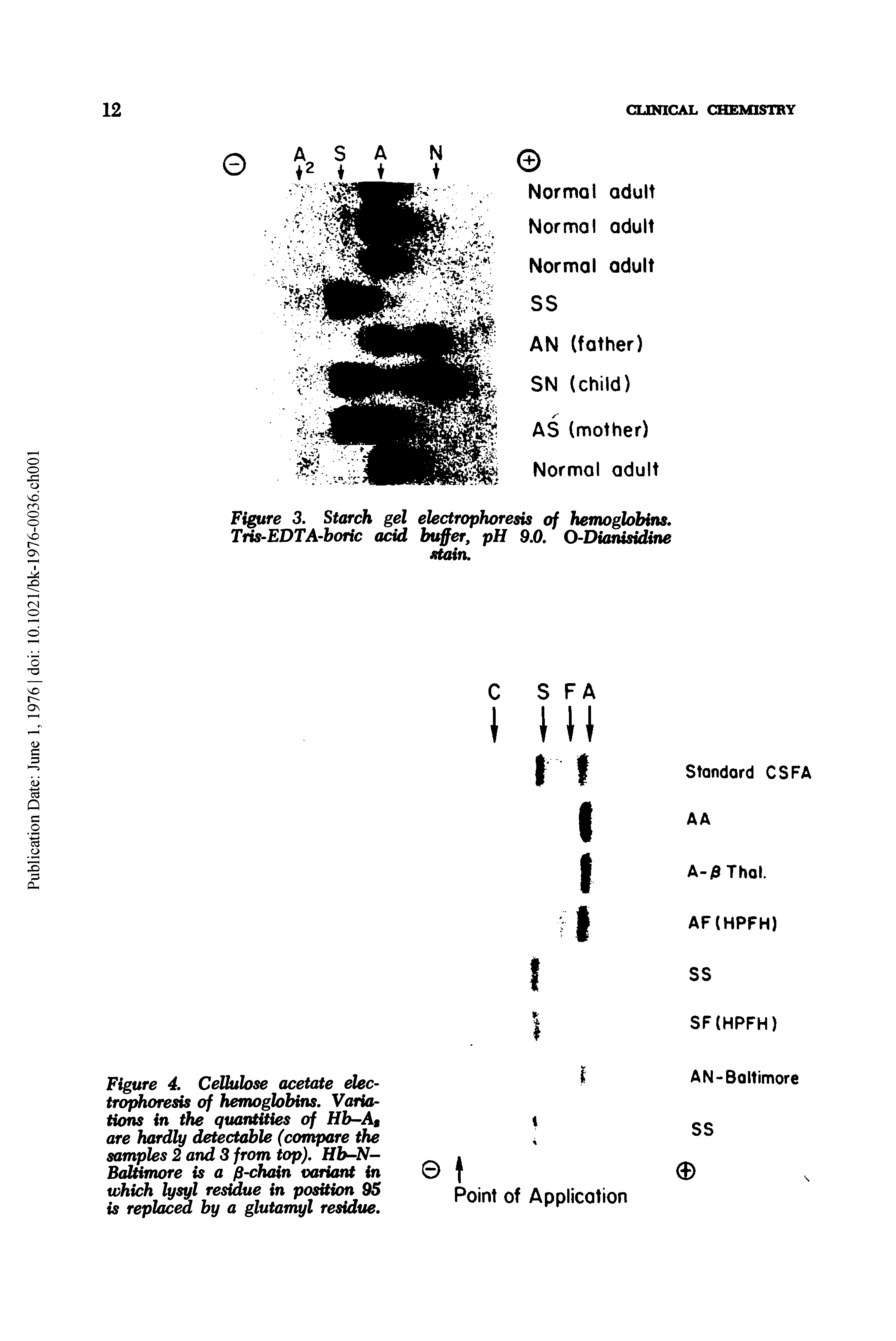 Figure 4. Cellulose acetate electrophoresis of hemoglobins. Variations in the quantities of Hb-Ag are hardly detectable (cornpare the samples 2 and 3 from top). Hb-N Baltimore is a p-chain variant in which lysyl residue in position 95 is replaced by a glutarnyl residue.