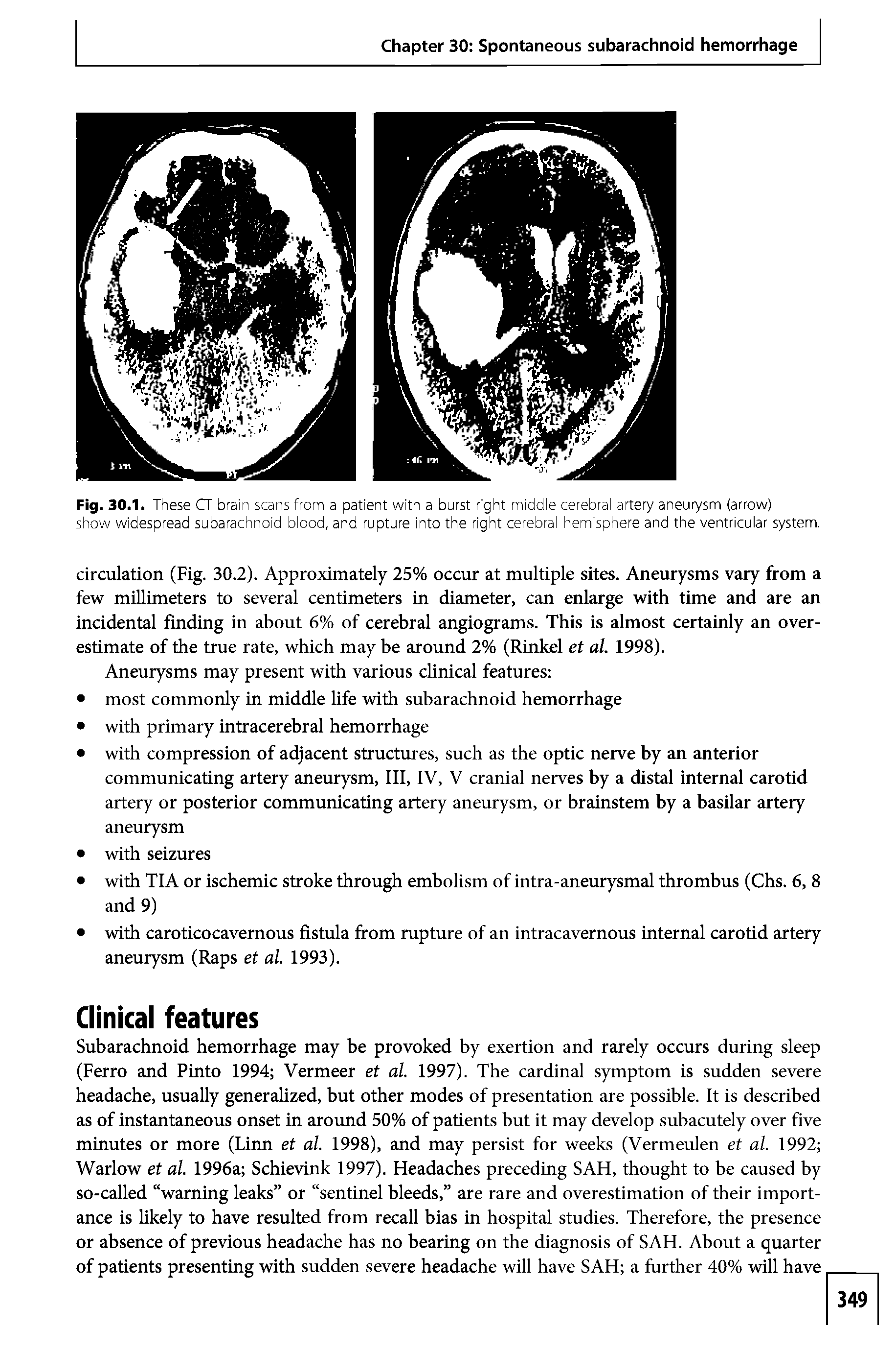 Fig. 30.1. These CT brain scans from a patient with a burst right middle cerebral artery aneurysm (arrow) show widespread subarachnoid blood, and rupture into the right cerebral hemisphere and the ventricular system.