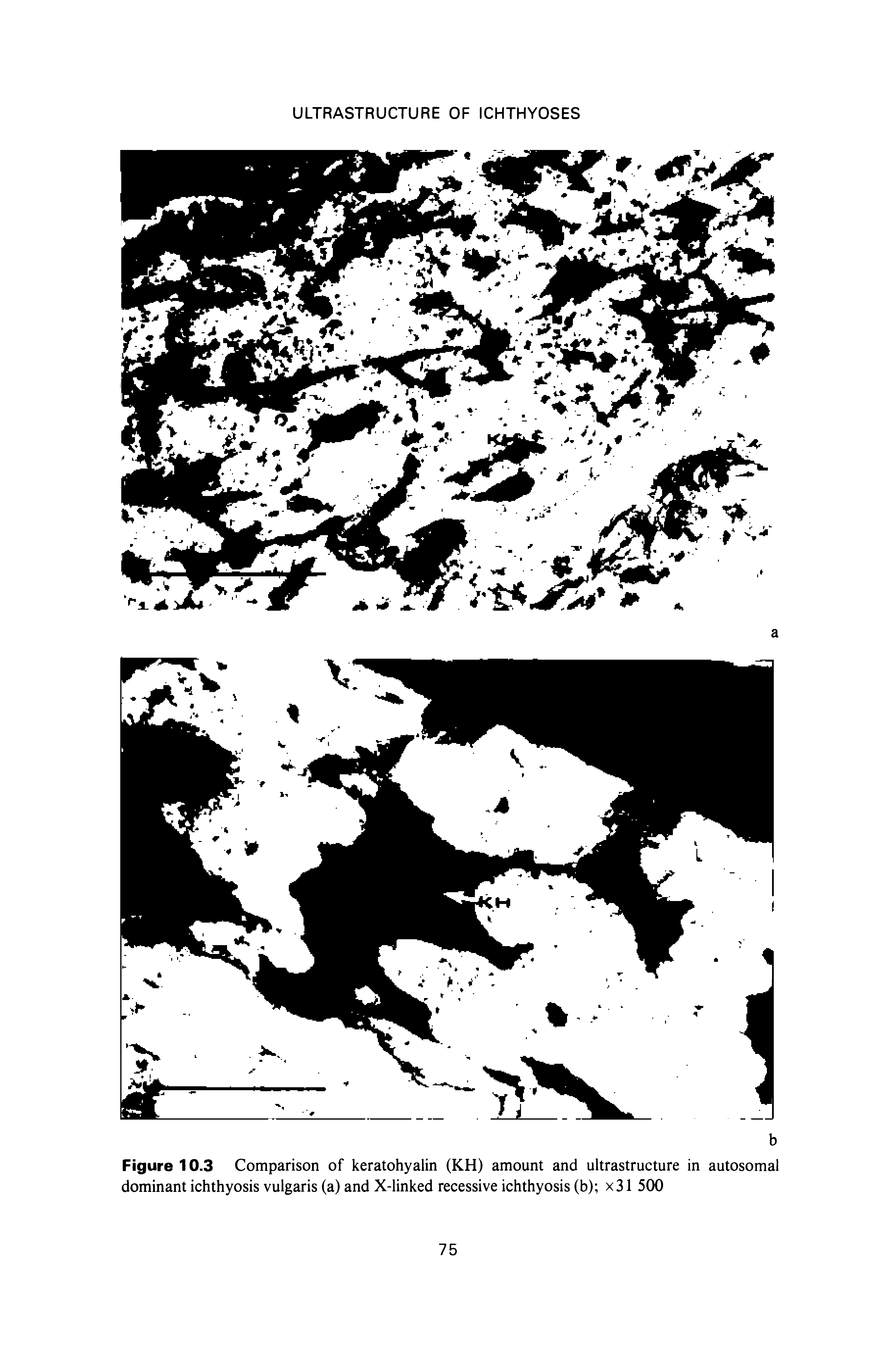 Figure 10.3 Comparison of keratohyalin (KH) amount and ultrastructure in autosomal dominant ichthyosis vulgaris (a) and X-linked recessive ichthyosis (b) x31 500...