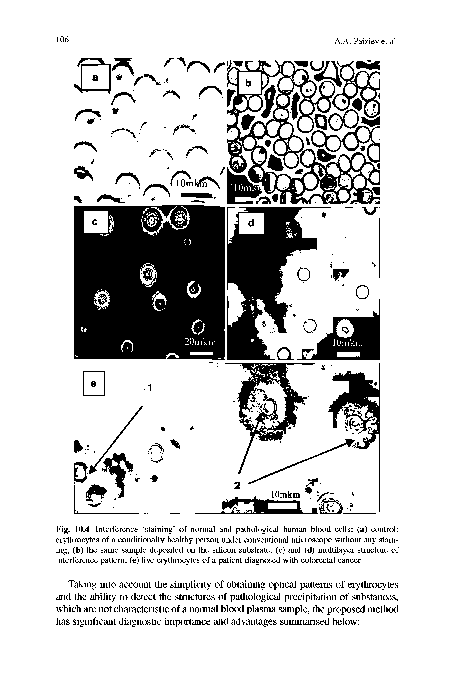 Fig. 10.4 Interference staining of normal and pathological human blood cells (a) control erythrocytes of a conditionally healthy person under conventional microscope without any staining, (b) the same sample deposited on the sdicon substrate, (c) and (d) multilayer structure of interference pattern, (e) live erythrocytes of a patient diagnosed with colorectal cancer...