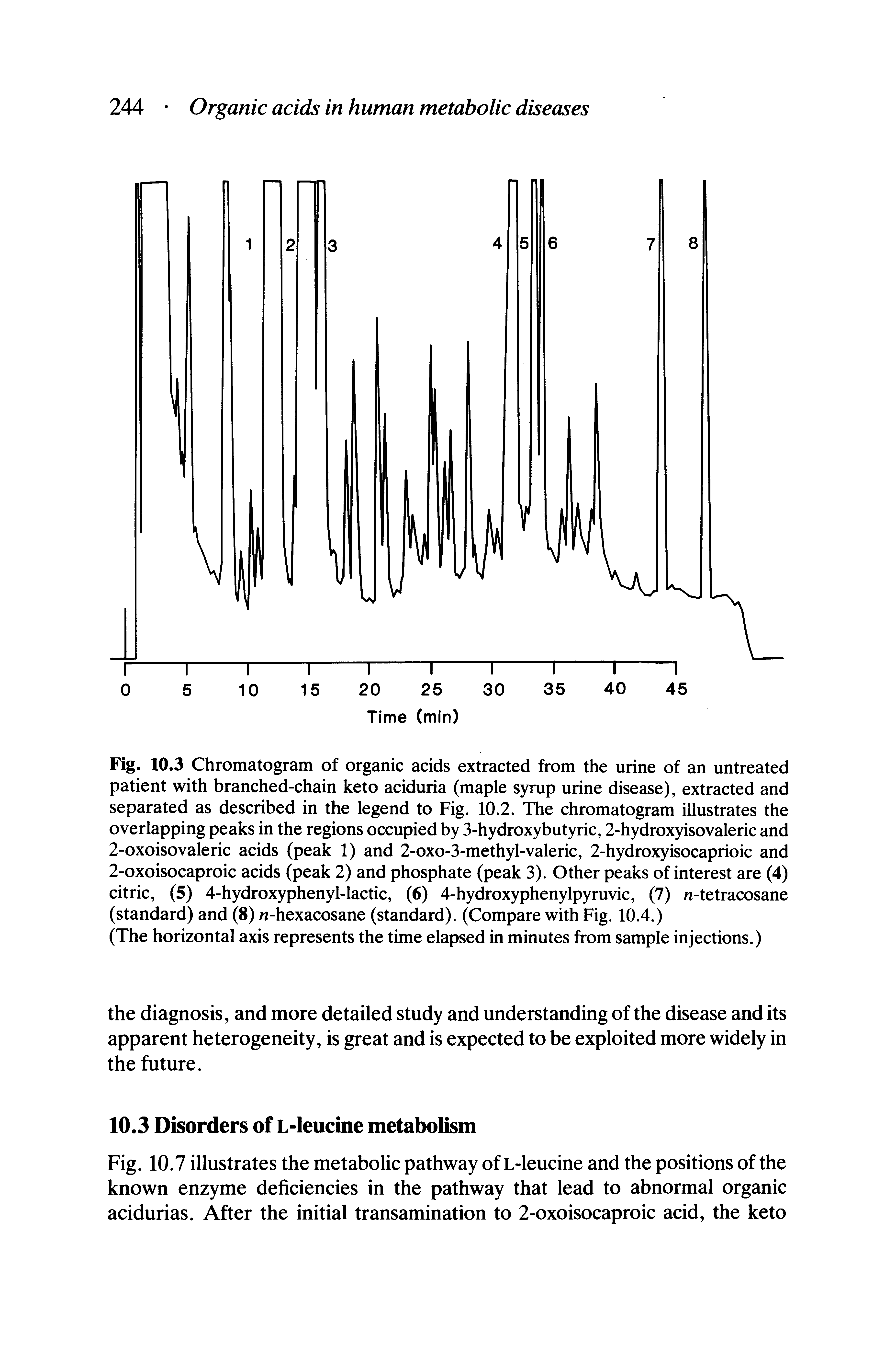 Fig. 10.3 Chromatogram of organic acids extracted from the urine of an untreated patient with branched-chain keto aciduria (maple syrup urine disease), extracted and separated as described in the legend to Fig. 10.2. The chromatogram illustrates the overlapping peaks in the regions occupied by 3-hydroxybutyric, 2-hydroxyisovaleric and 2-oxoisovaleric acids (peak 1) and 2-oxo-3-methyl-valeric, 2-hydroxyisocaprioic and 2-oxoisocaproic acids (peak 2) and phosphate (peak 3). Other peaks of interest are (4) citric, (5) 4-hydroxyphenyl-lactic, (6) 4-hydroxyphenylpyruvic, (7) n-tetracosane (standard) and (8) -hexacosane (standard). (Compare with Fig. 10.4.)...