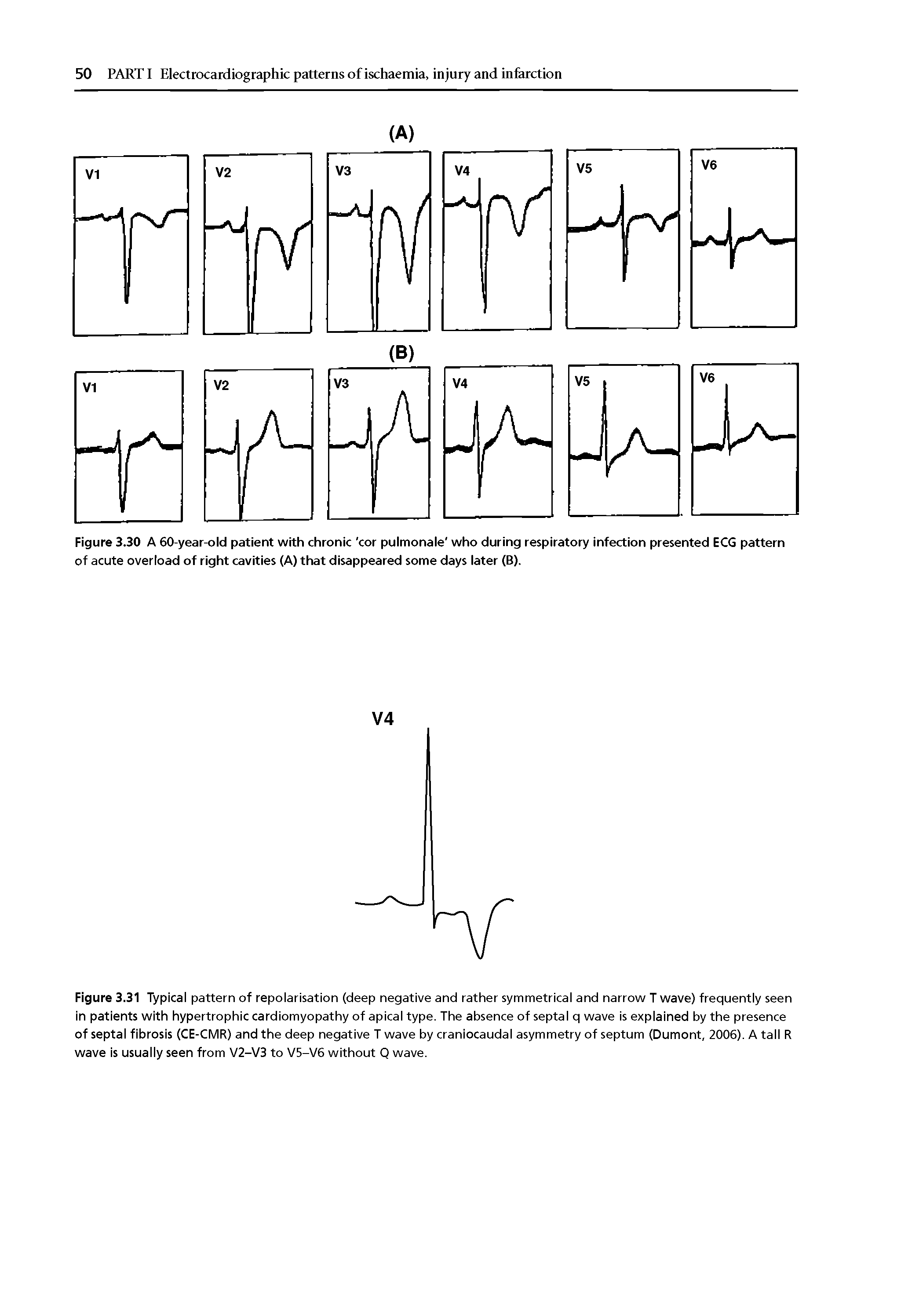 Figure 3.31 Typical pattern of repolarisation (deep negative and rather symmetrical and narrow T wave) frequently seen in patients with hypertrophic cardiomyopathy of apical type. The absence of septal q wave is explained by the presence of septal fibrosis (CE-CMR) and the deep negative T wave by craniocaudal asymmetry of septum (Dumont, 2006). A tall R wave is usually seen from V2-V3 to V5-V6 without Q wave.
