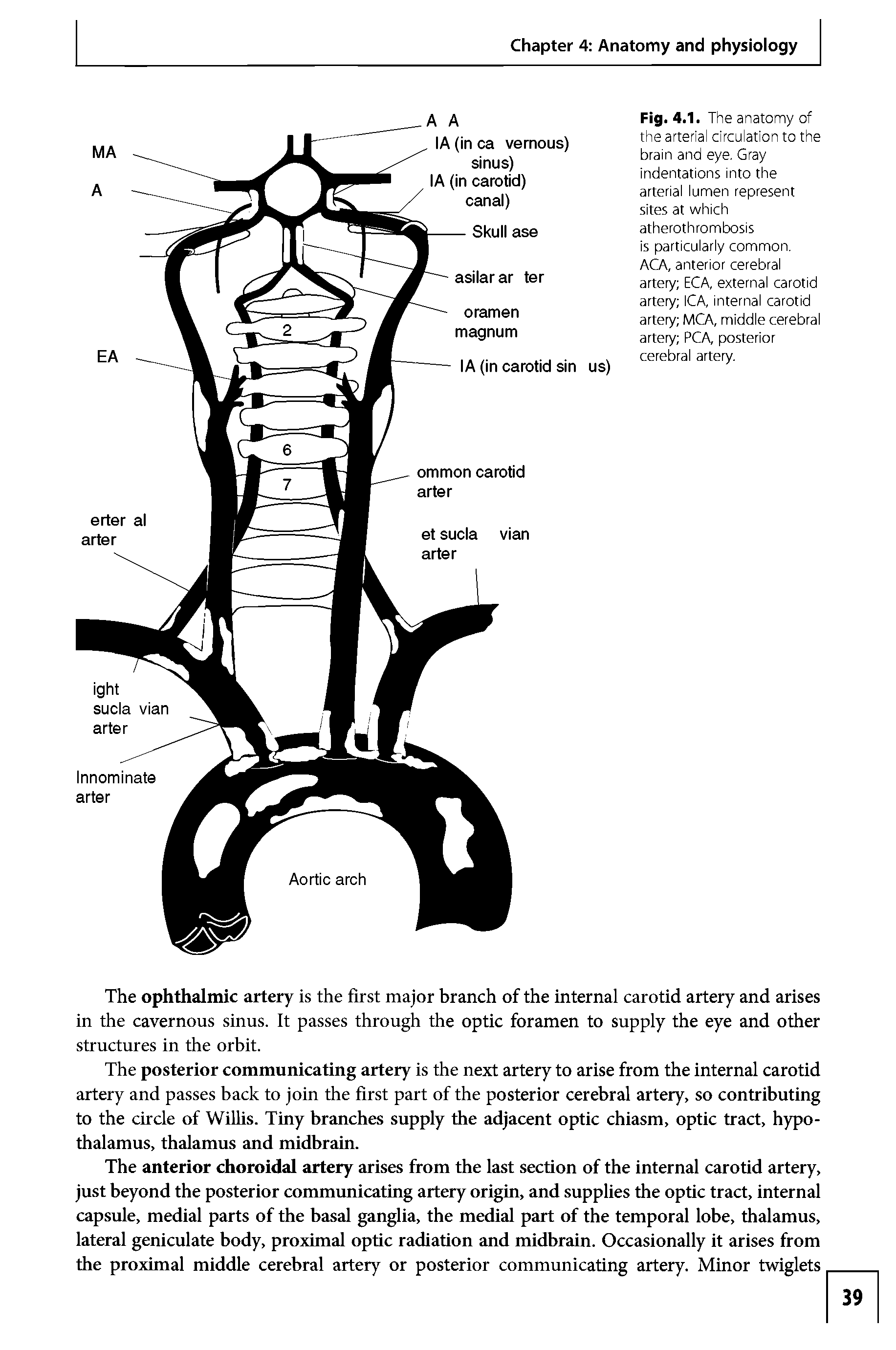 Fig. 4.1. The anatomy of the arterial circulation to the brain and eye. Gray indentations into the arterial lumen represent sites at which atherothrombosis is particularly common. ACA, anterior cerebral artery EGA, external carotid artery ICA, internal carotid artery MCA, middle cerebral artery PCA, posterior cerebral artery.