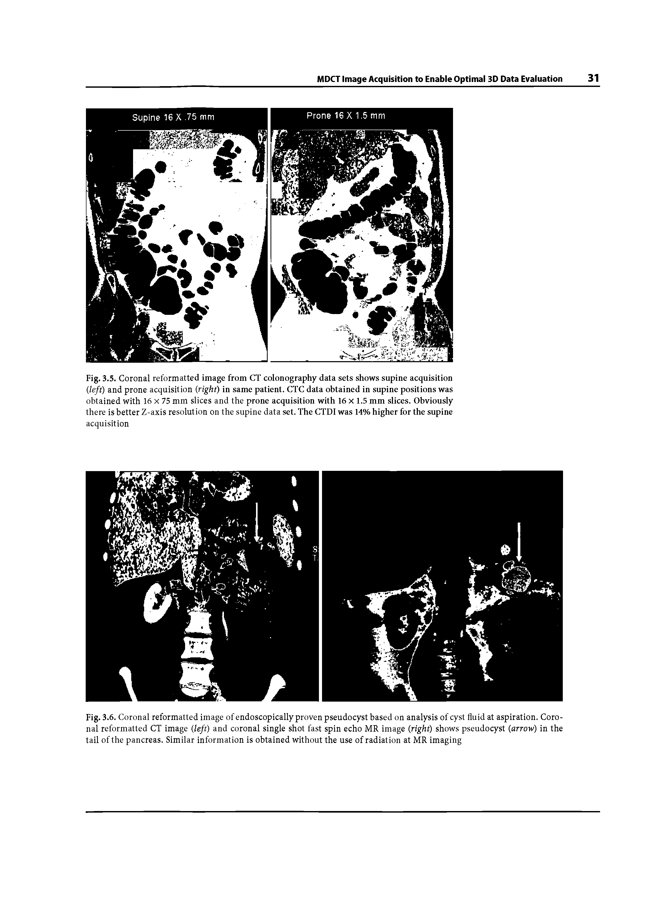 Fig. 3.5. Coronal reformatted image from CT colonography data sets shows supine acquisition (left) and prone acquisition (right) in same patient. CTC data obtained in supine positions was obtained with 16 x 75 mm slices and the prone acquisition with 16 x 1.5 mm slices. Obviously there is better Z-axis resolution on the supine data set. The CTDI was 14% higher for the supine acquisition...