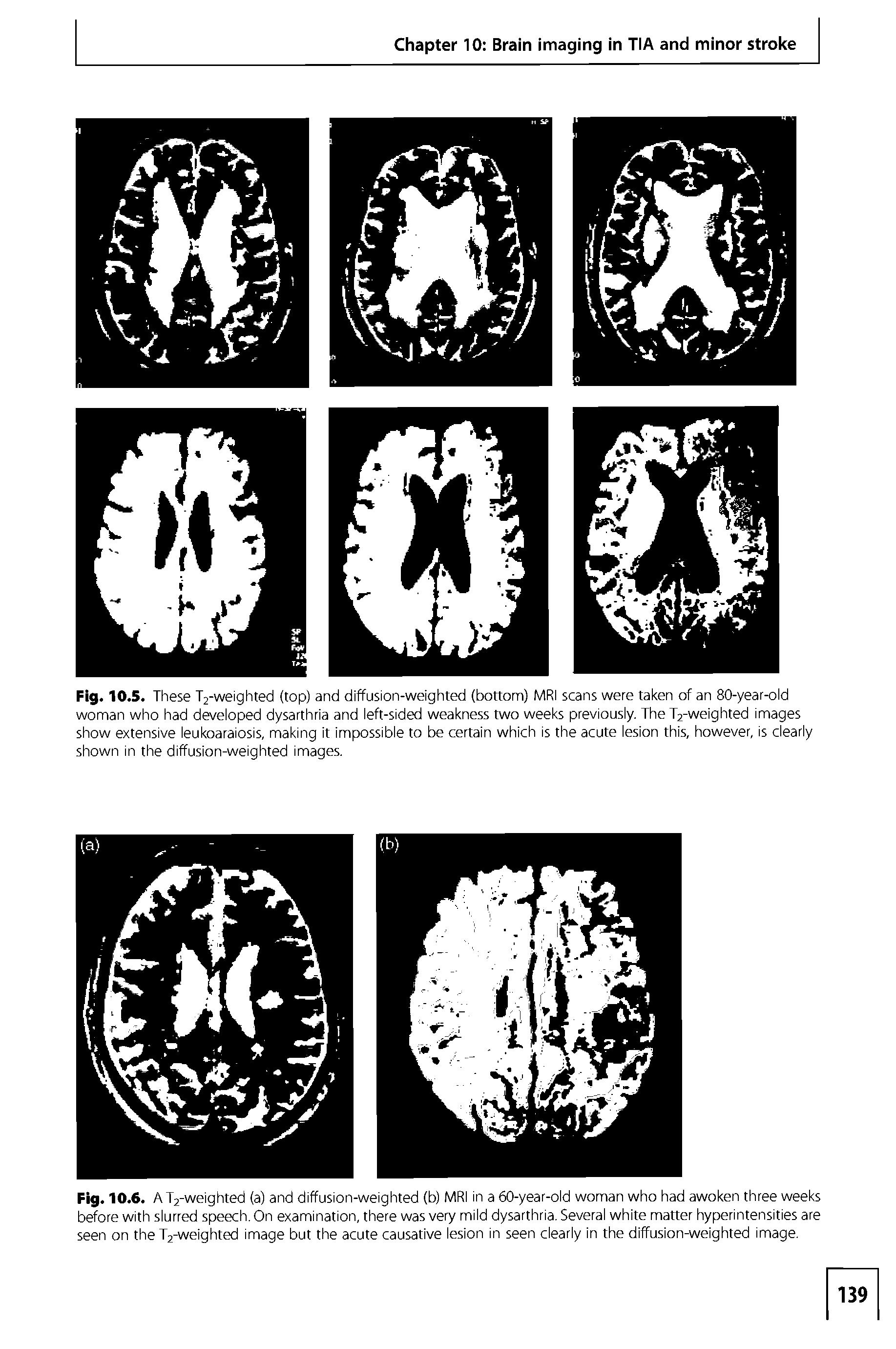 Fig. 10.6. AT2-weighted (a) and diffusion-weighted (b) MRI in a 60-year-old woman who had awoken three weeks before with slurred speech. On examination, there was very mild dysarthria. Several white matter hyperintensities are seen on the T2-weighted image but the acute causative lesion in seen clearly in the diffusion-weighted image.
