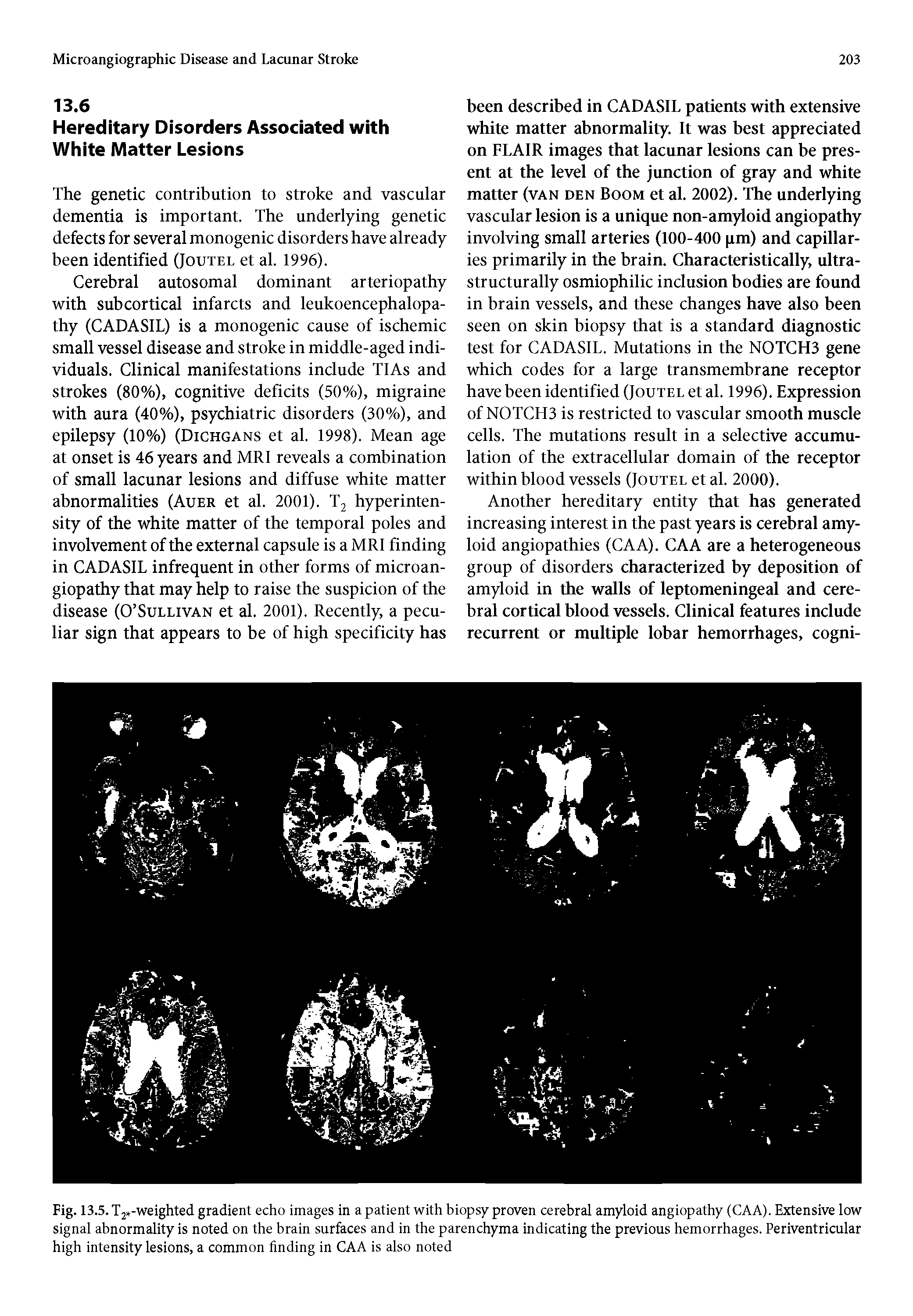 Fig. 13.5. T2 -weighted gradient echo images in a patient with biopsy proven cerebral amyloid angiopathy (CAA). Extensive low signal abnormality is noted on the brain surfaces and in the parenchyma indicating the previous hemorrhages. Periventricular high intensity lesions, a common finding in CAA is also noted...