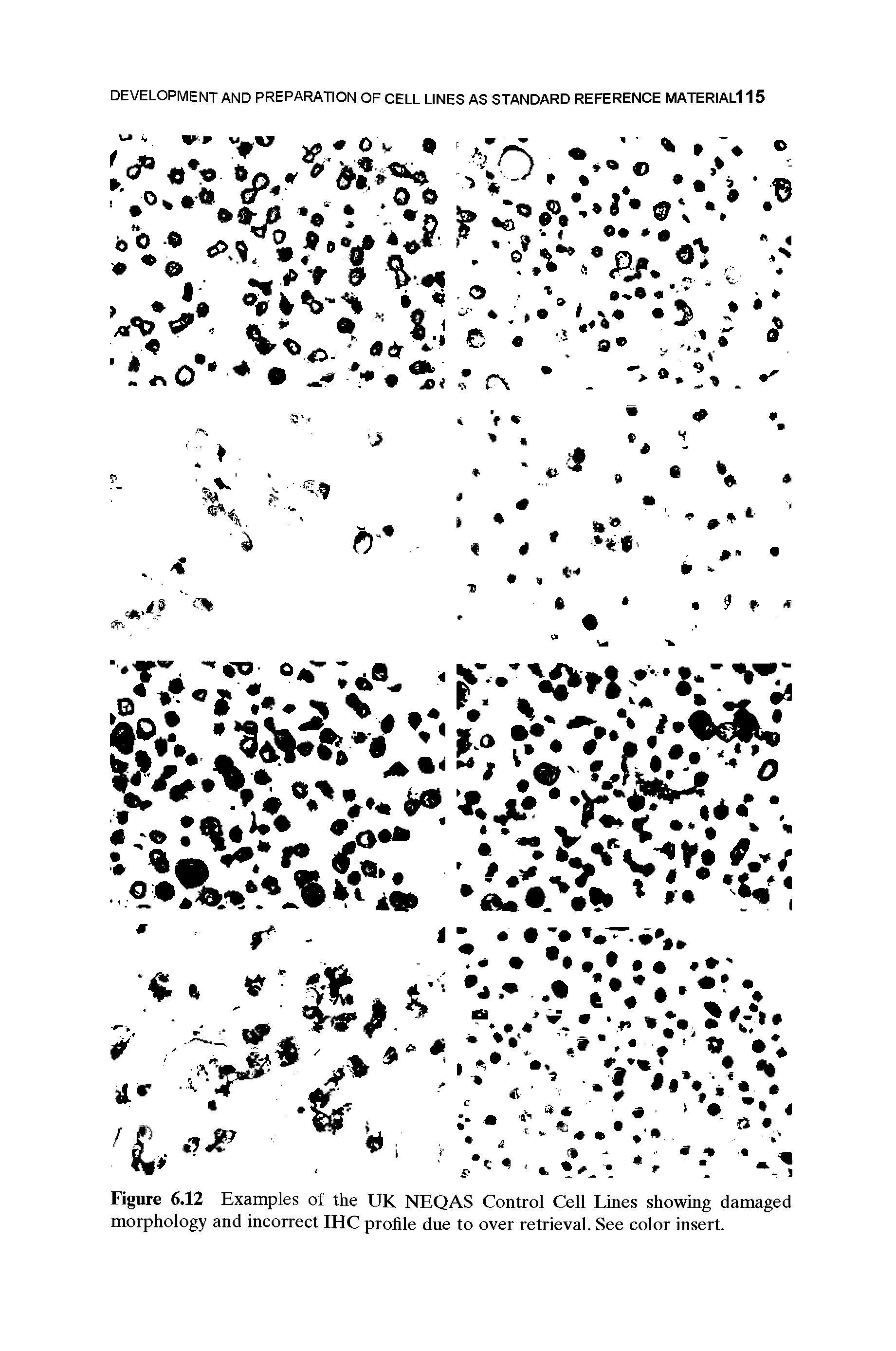 Figure 6.12 Examples of the UK NEQAS Control Cell Lines showing damaged morphology and incorrect IHC profile due to over retrieval. See color insert.