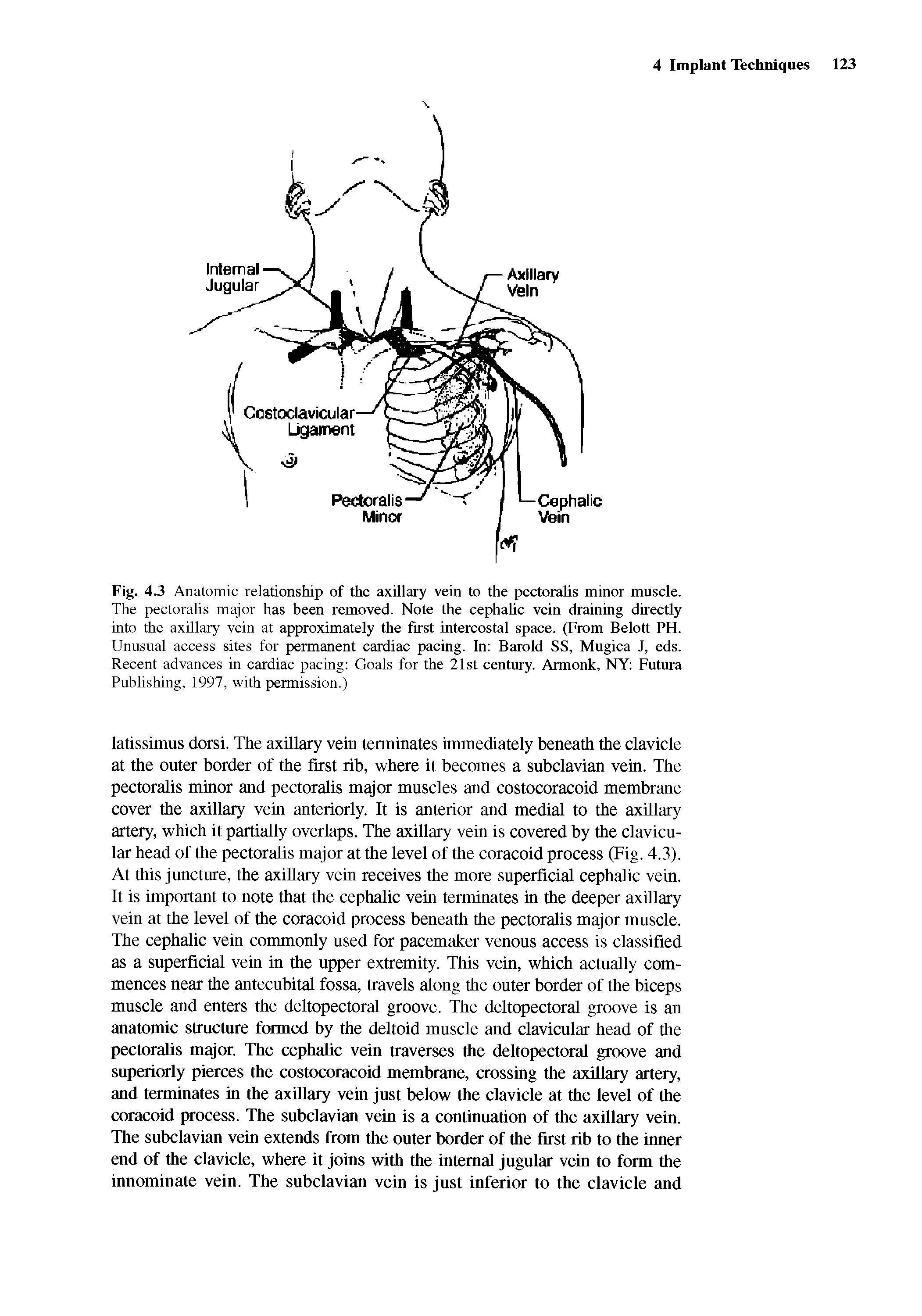 Fig. 4.3 Anatomic relationship of the axillary vein to the pectoralis minor muscle. The pectoralis major has been removed. Note the cephalic vein draining directly into the axillary vein at approximately the first intercostal space. (From Belott PH. Unusual access sites for permanent cardiac pacing. In Barold SS, Mugica J, eds. Recent advances in cardiac pacing Goals for the 21st century. Armonk, NY Futura Publishing, 1997, with permission.)...