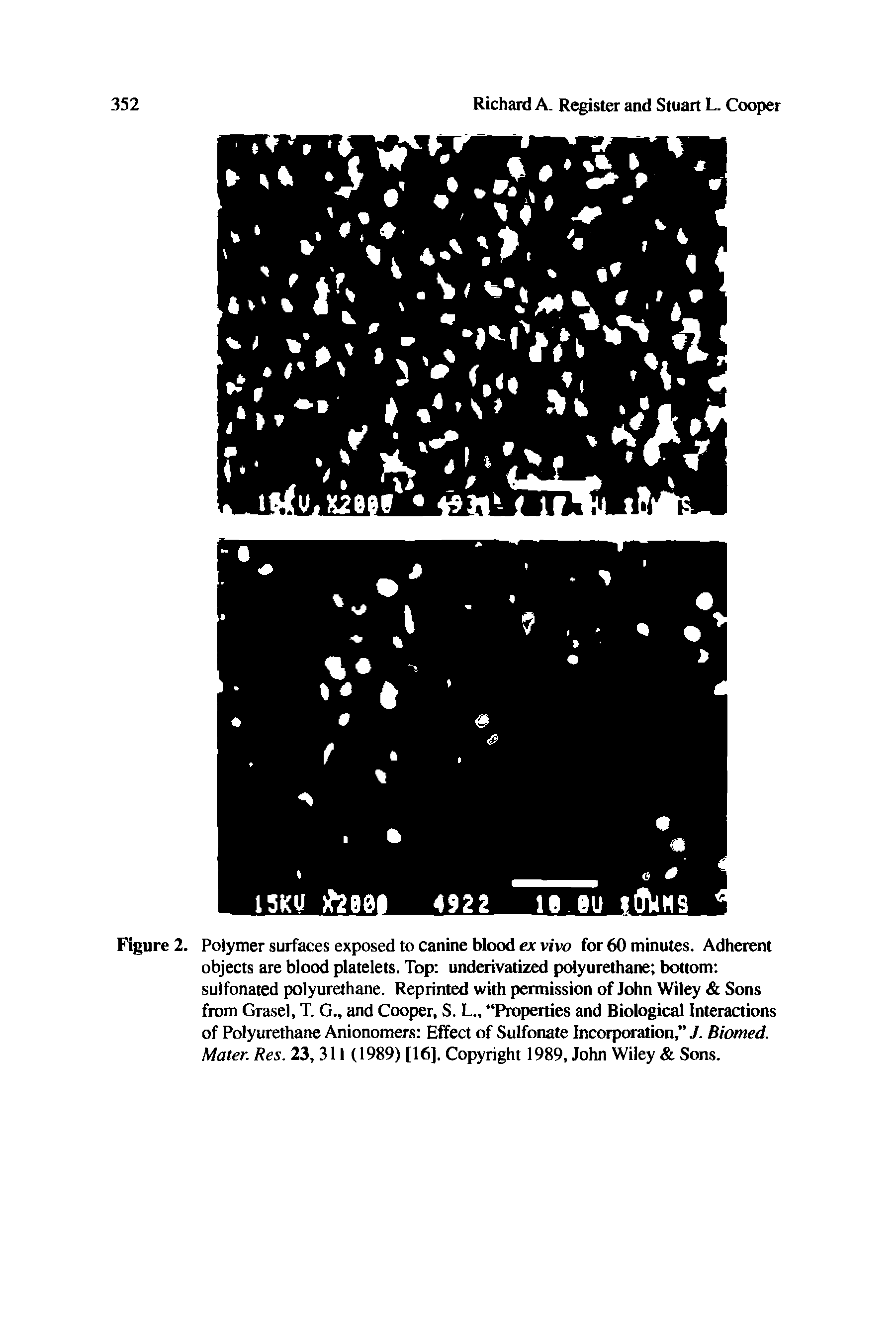 Figure 2. Polymer surfaces exposed to canine blood ex vivo for 60 minutes. Adherent objects are blood platelets. Top underivatized polyurethane bottom sulfonated polyurethane. Reprinted with permission of John Wiley Sons from Grasel, T. G., and Cooper, S. L Properties and Biological Interactions of Polyurethane Anionomers Effect of Sulfonate Incorporation, J. Biomed. Mater. Res. 23, 311 (1989) [16], Copyright 1989, John Wiley Sons.