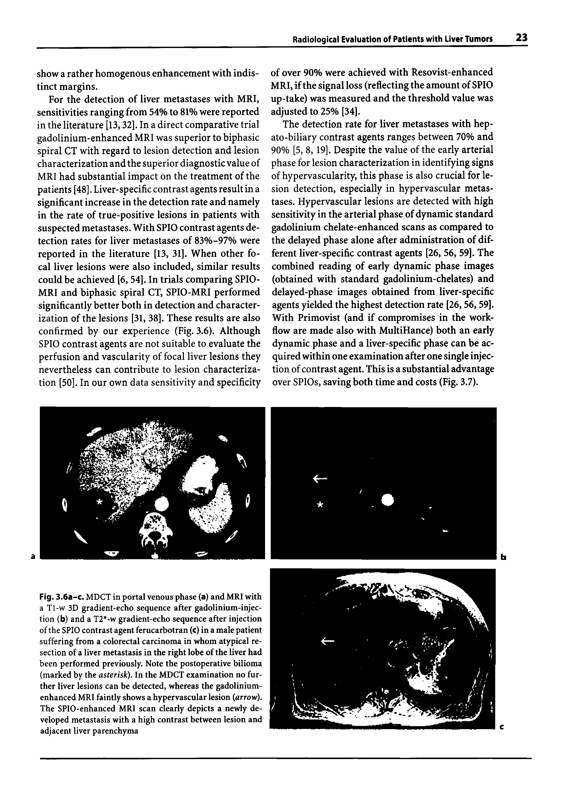 Fig. 3.6a-C. MDCT in portal venous phase (a) and MRI with a Tl-w 3D gradient-echo sequence after gadolinium-injection (b) and a T2 -w gradient-echo sequence after injection of the SPIO contrast agent ferucarbotran (c) in a male patient suffering from a colorectal carcinoma in whom atypical resection of a liver metastasis in the right lobe of the liver had been performed previously. Note the postoperative bilioma (marked by the asterisk). In the MDCT examination no further liver lesions can be detected, whereas the gadolinium-enhanced MRI faintly shows a hypervascular lesion arrow). The SPlO-enhanced MRI scan clearly depicts a newly developed metastasis with a high contrast between lesion and adjacent liver parenchyma...