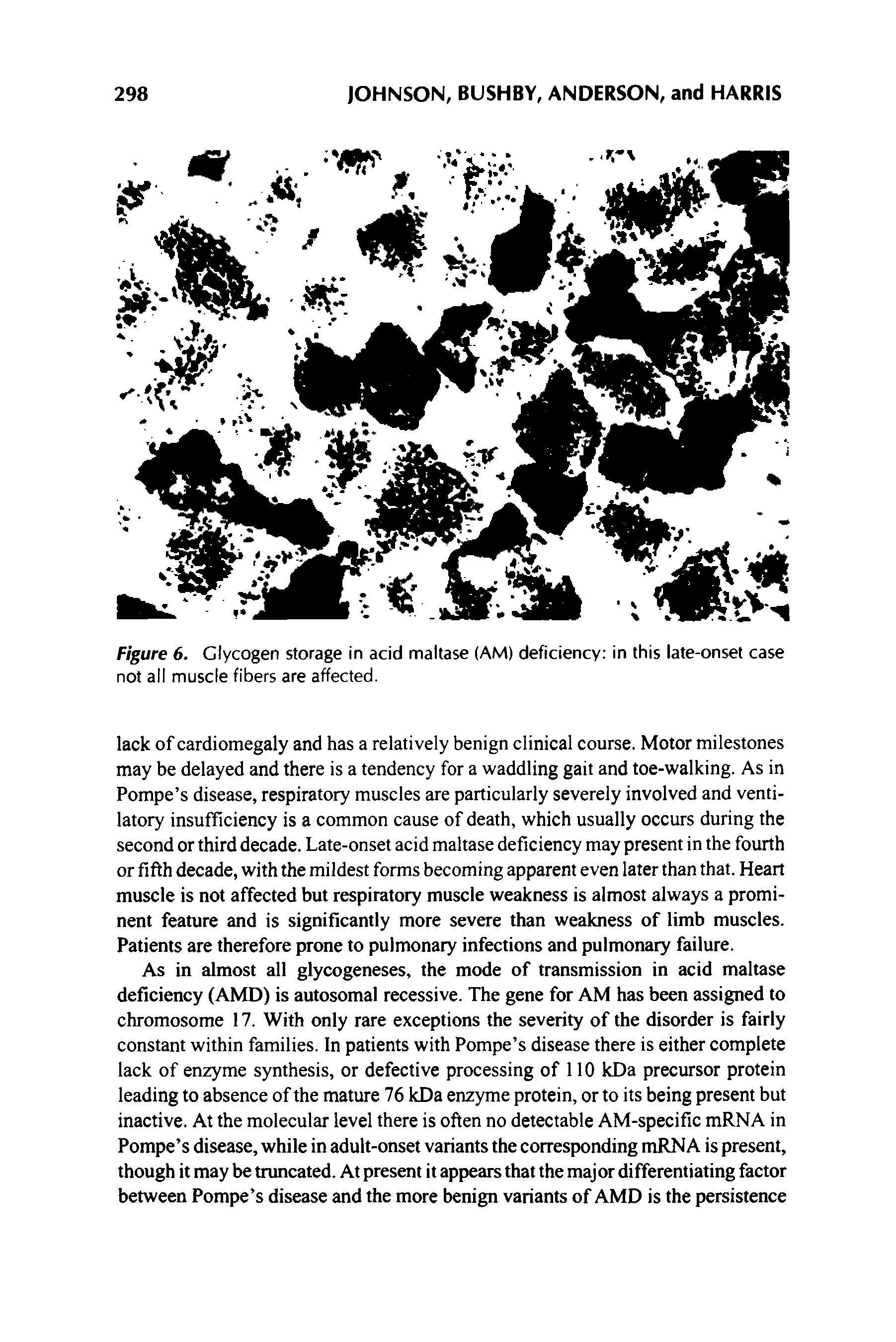 Figure 6. Glycogen storage in acid maltase (AM) deficiency in this late-onset case not all muscle fibers are affected.